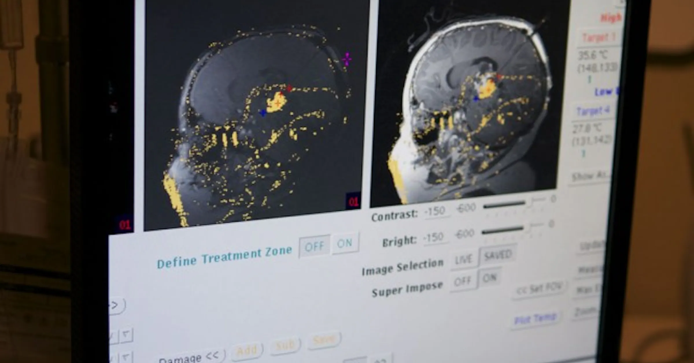 Visualase System Tech Spotlight: A look at Visualase, a minimally invasive laser surgery ...