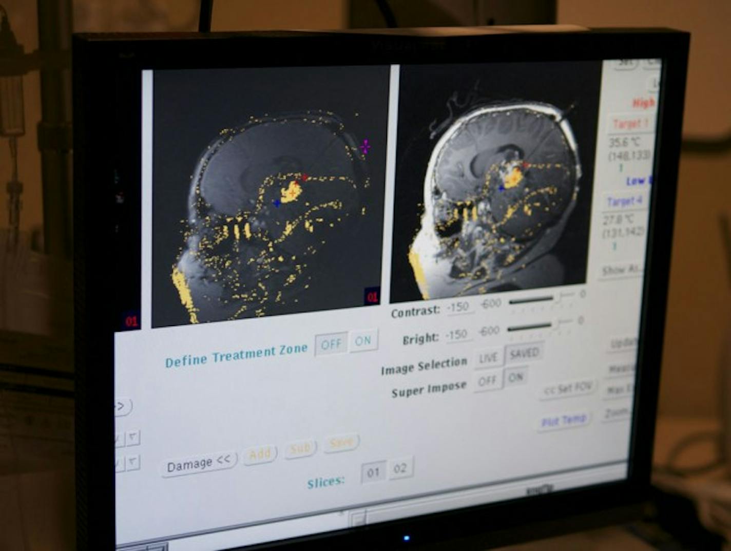 Visualase's workstation interfaces with an MRI to allow temperature control and monitoring in real time during a treatment.