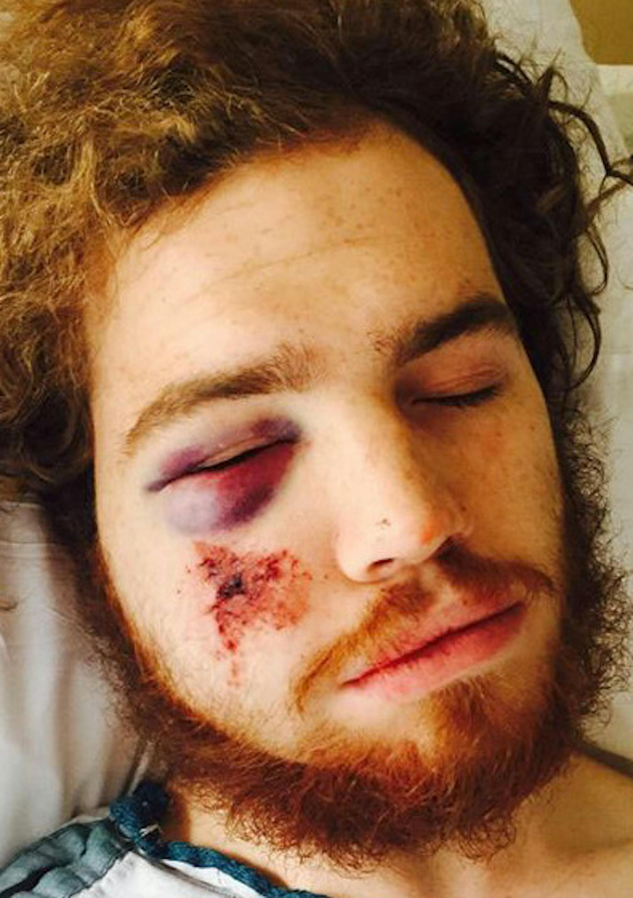 Mackenzie Jensen was one of two people struck about 5:30 p.m. Friday, Sept. 7, 2015, with cement-type material &#xcf;within seconds of each other&#xd3; near W. 41st Street and Bryant Avenue S. One person had minor injuries, but the second, Jensen, was struck in the face and suffered multiple facial fractures that will require two surgeries. Provided by family. ORG XMIT: MIN1508101601330621