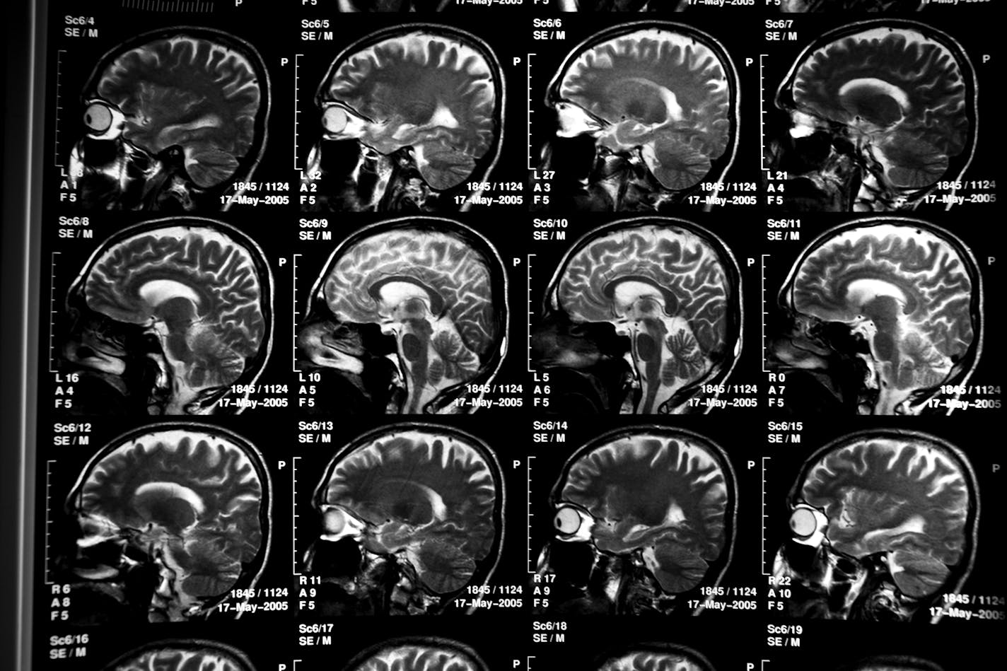 FILE-- Scans of Carlos Cuarta's brain, who suffers from Alzheimer's disease, in Yarumal, Colombia, Feb. 2, 2010. All three of Cuarta's children were afflicted with the disease while in their 40's. Federal officials in the U.S., on May 15, 2012, announced a clinical drug trial, which could lead to treatments for Alzheimer's disease for people who are genetically guaranteed to suffer from the disease but do not yet have any symptoms. (Todd Heisler/The New York Times)