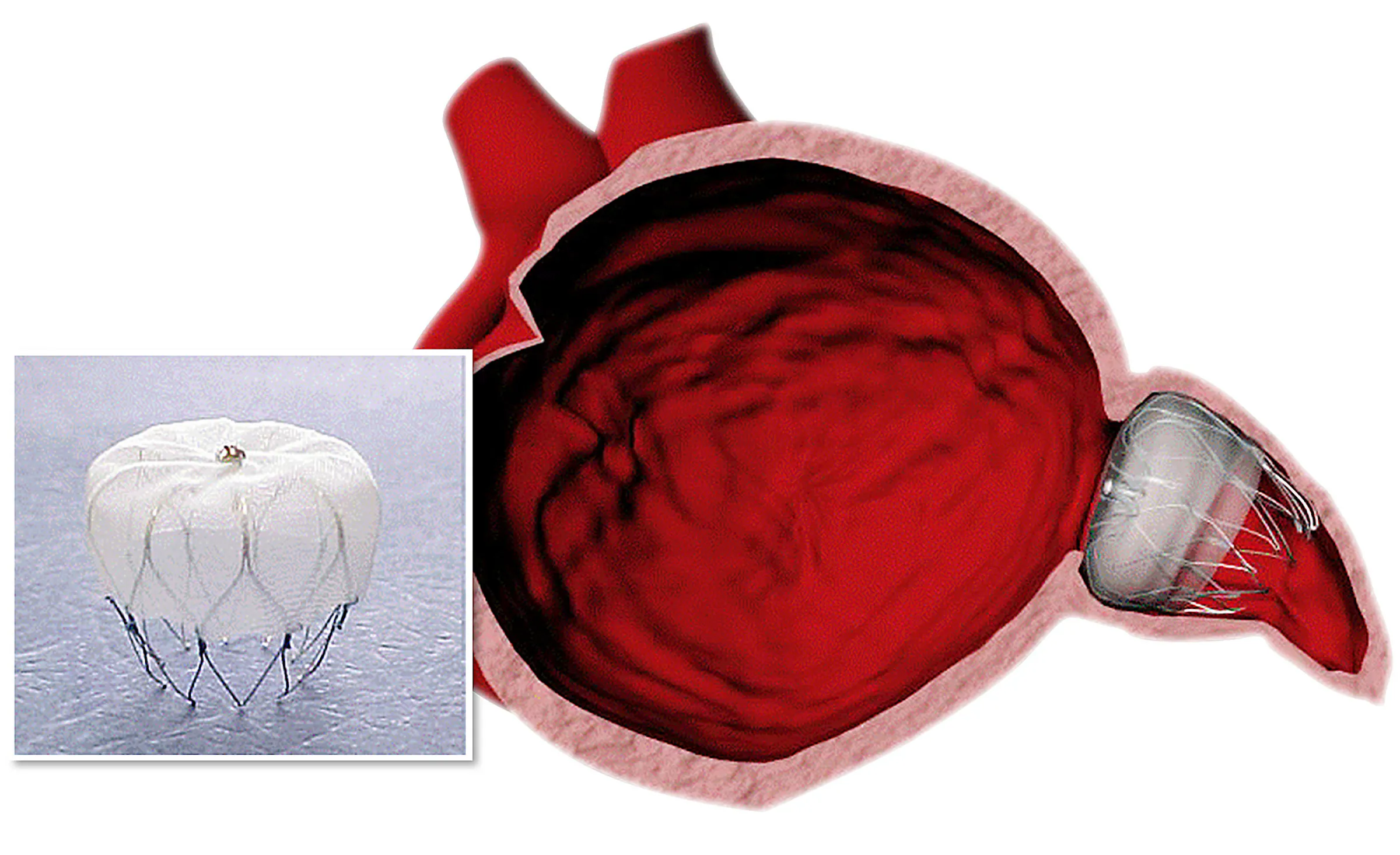 Device developed in Minneapolis has potential to help heart patients
