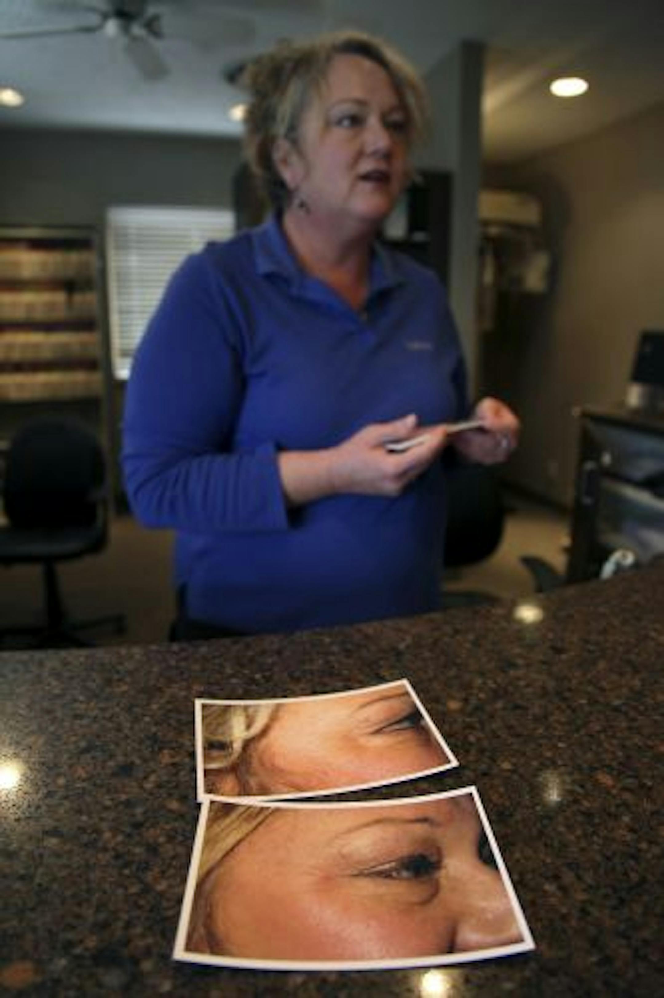 Dr. Michael Skadron's receptionist Robyn Nelson, showed off her before and after photos after she received botox injections at West River Dental Care.