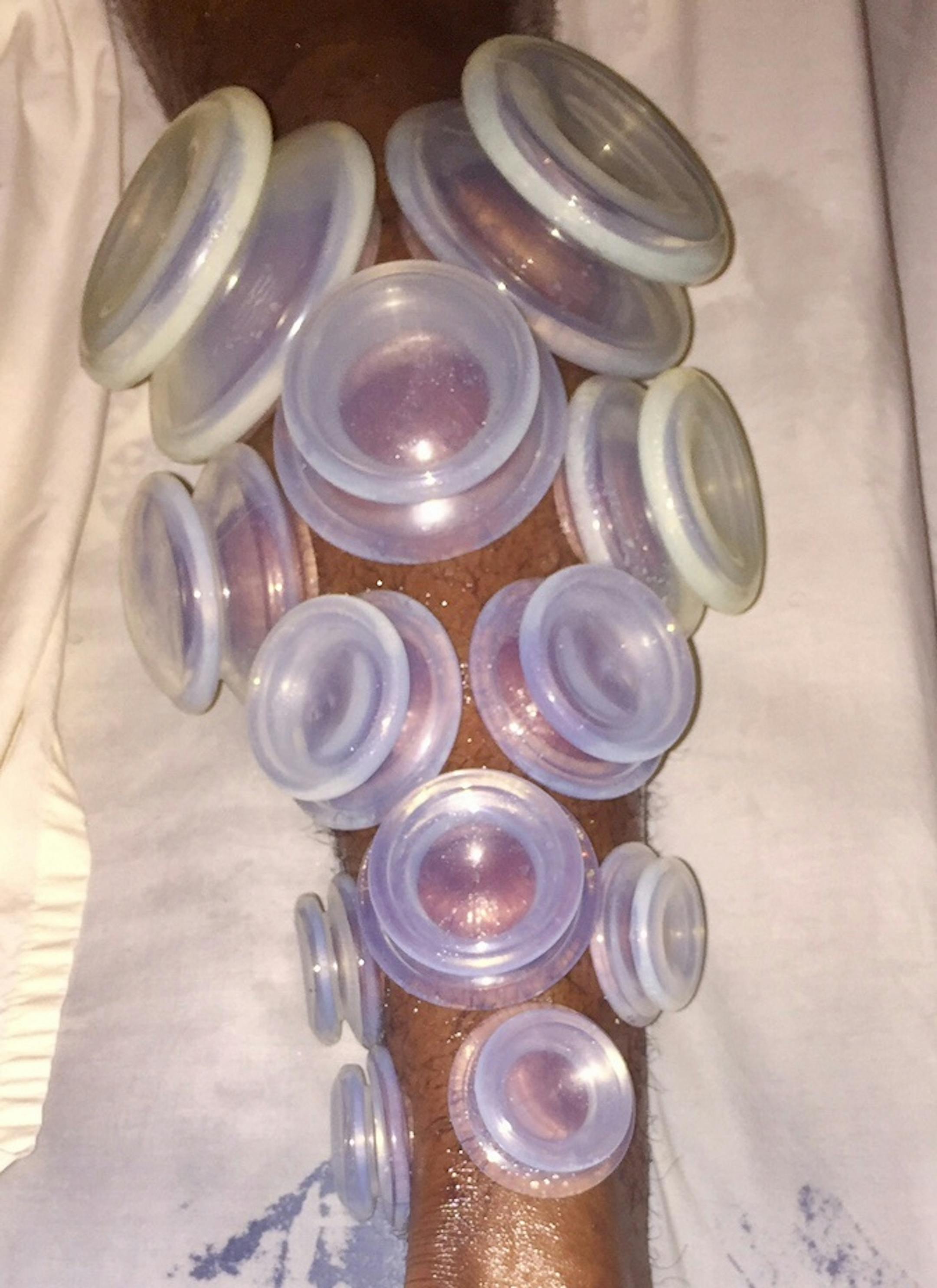 John Lucas III of the Timberwolves using cupping therapy on his leg. photo courtesy John Lucas III