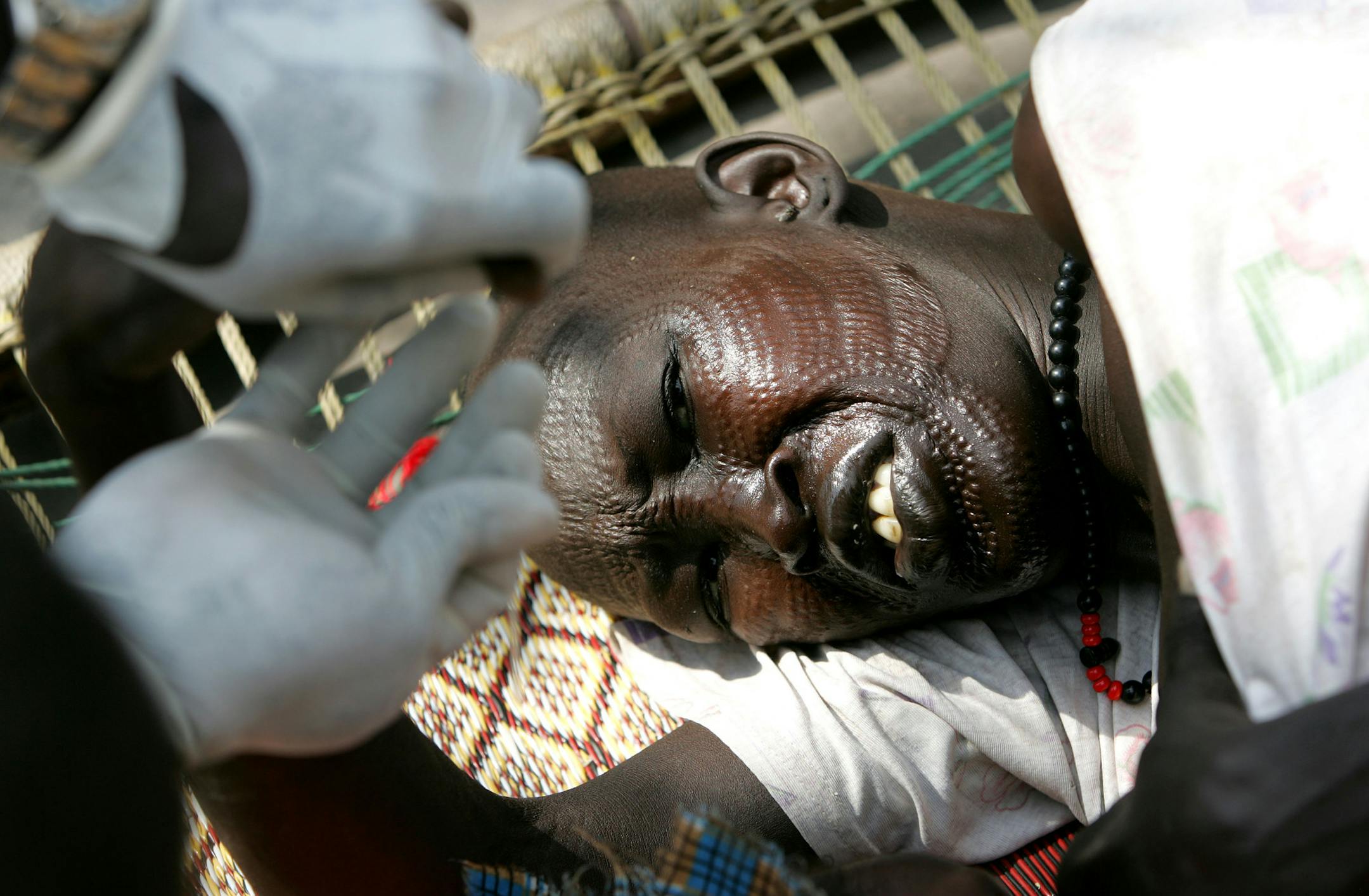 **FILE** Nyatudy Riak Marial , who is suspected to suffer from the parasitic disease Kala azar, is undergoing a rapid Kala azar test at a Medicins Sans Frontieres clinic in this Saturday, Dec. 17, 2005 file picture in Kotch in Southern Sudan.The sickness starts with the bite of a tiny sand fly and mutates quickly from there _ chills, then fever, then an onslaught of black lesions that will most likely prove fatal within six months without treatment.Known as kala azar _ a Hindi word meaning Black