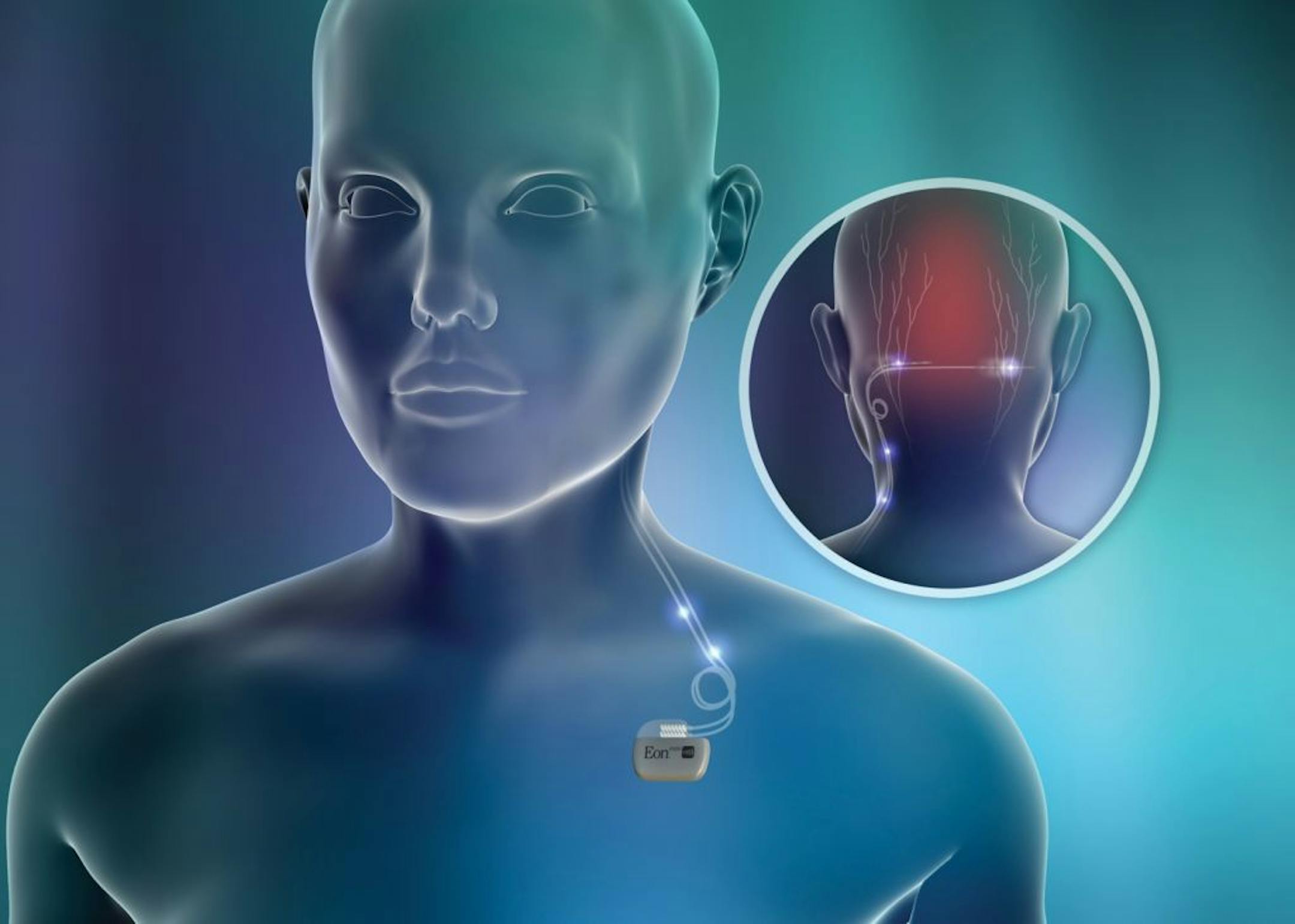 St. Jude's Eon device is a tiny pacemaker that is implanted either near the hip or in the chest area. Small wires, or leads, with electrodes run from the device, just beneath the skin, to the base of the skull. There, they deliver a programmable pulse of energy to the occipital nerve to alleviate migraine pain.