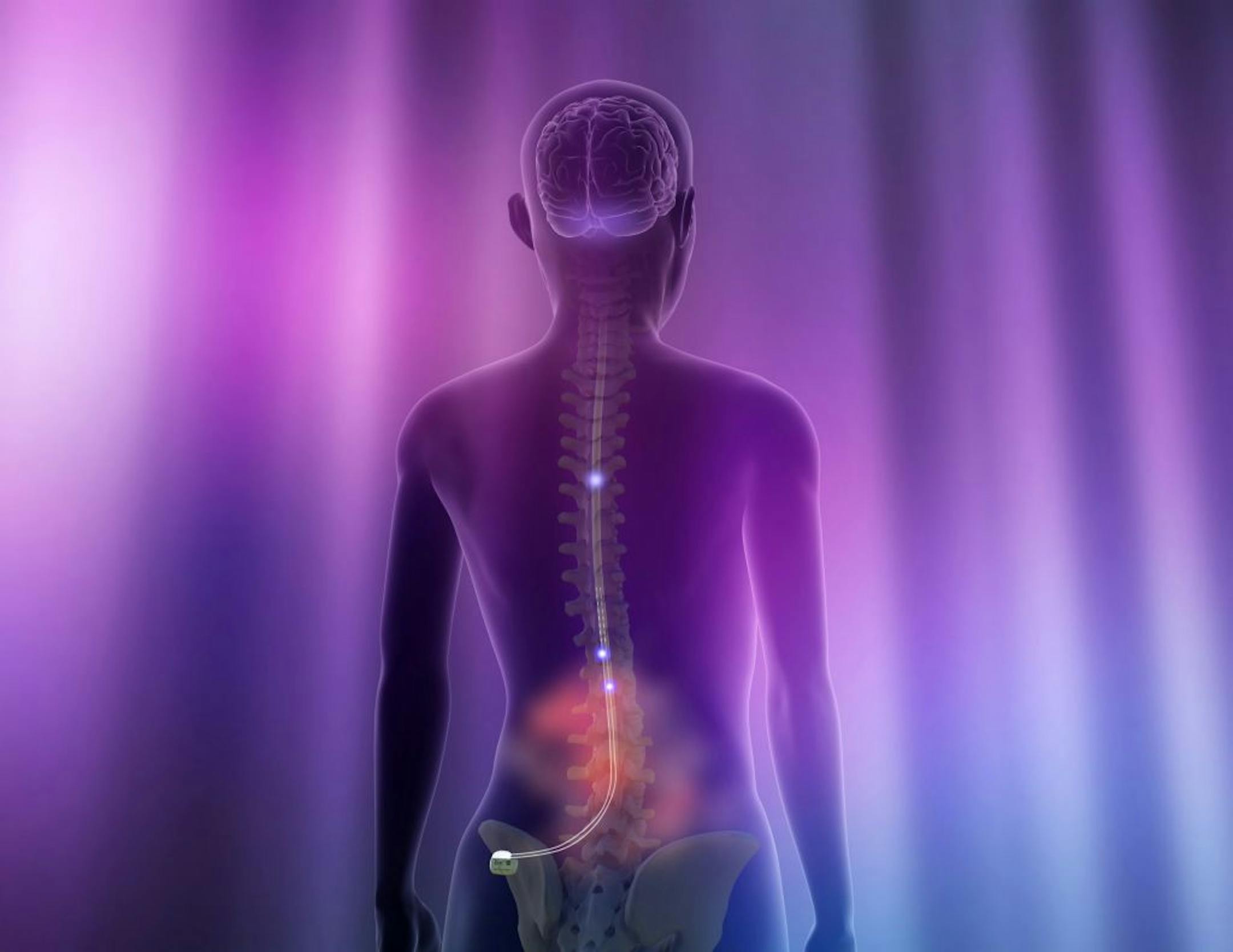 Illustration of a female patient receiving neurostimulation for pain relief with the Eon Mini� neurostimulator, the world�s smallest rechargeable spinal cord stimulator1-4. The device typically implanted in the buttock area, sends mild electrical pulses to leads located near the spinal cord. These pulses interrupt the pain signals as they travel to the brain.
St. Jude Medical