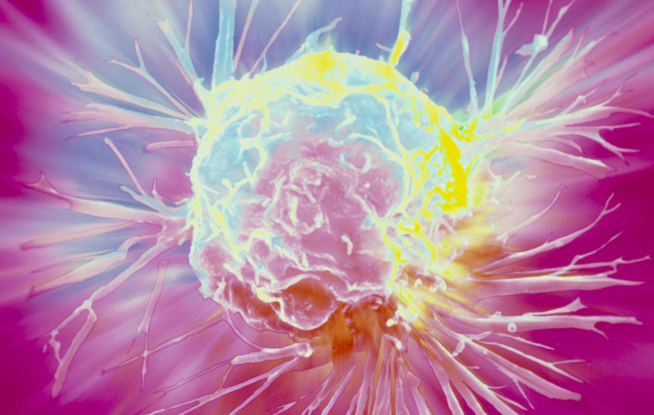 Breast cancer cell. Coloured scanning electron micrograph (SEM) of a single breast cancer cell, showing its uneven surface and cytoplasmic projections. Clumps of cancerous (malignant) cells form tumours, which possess the ability to invade and destroy surrounding tissues and travel to distant parts of the body to seed secondary tumours. Malignant cells proliferate and grow in a chaotic manner, with defective cell division retained within each new generation of cells. Variations also occur in siz