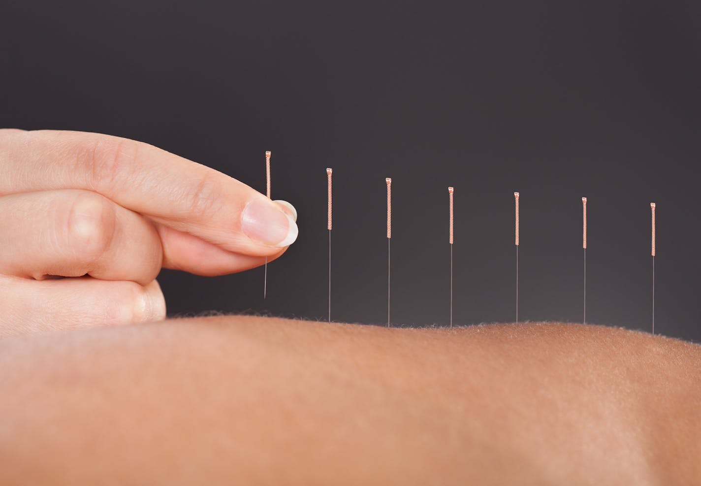 Close-up Of A Person Getting An Acupuncture Treatment At Spa