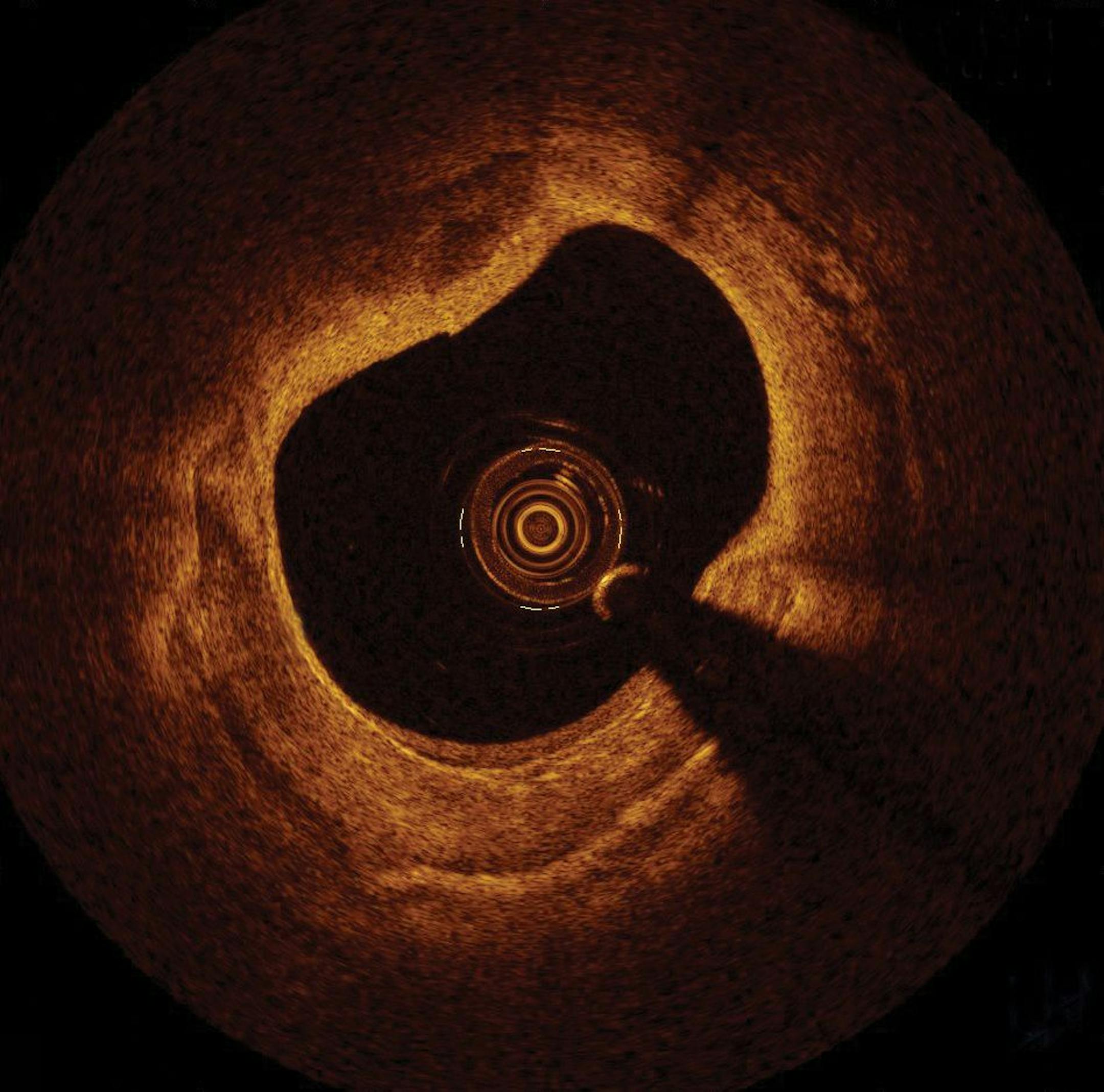 The images transmitted by the Ilumien PCI Optimization System allow physicians to view the inside of a blood vessel.
