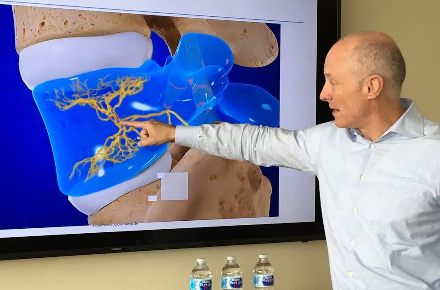 Relievant Medsystems CEO Kevin Hykes demonstrates where radiofrequency energy is applied to sever the basivertebral nerve, in yellow, during the &#x201c;Intracept&#x201d; procedure for certain forms of lower back pain. The company makes equipment and supplies for the procedure, including an electrode-tipped catheter inserted into lower-spine vertebrae to permanently zap the nerve.