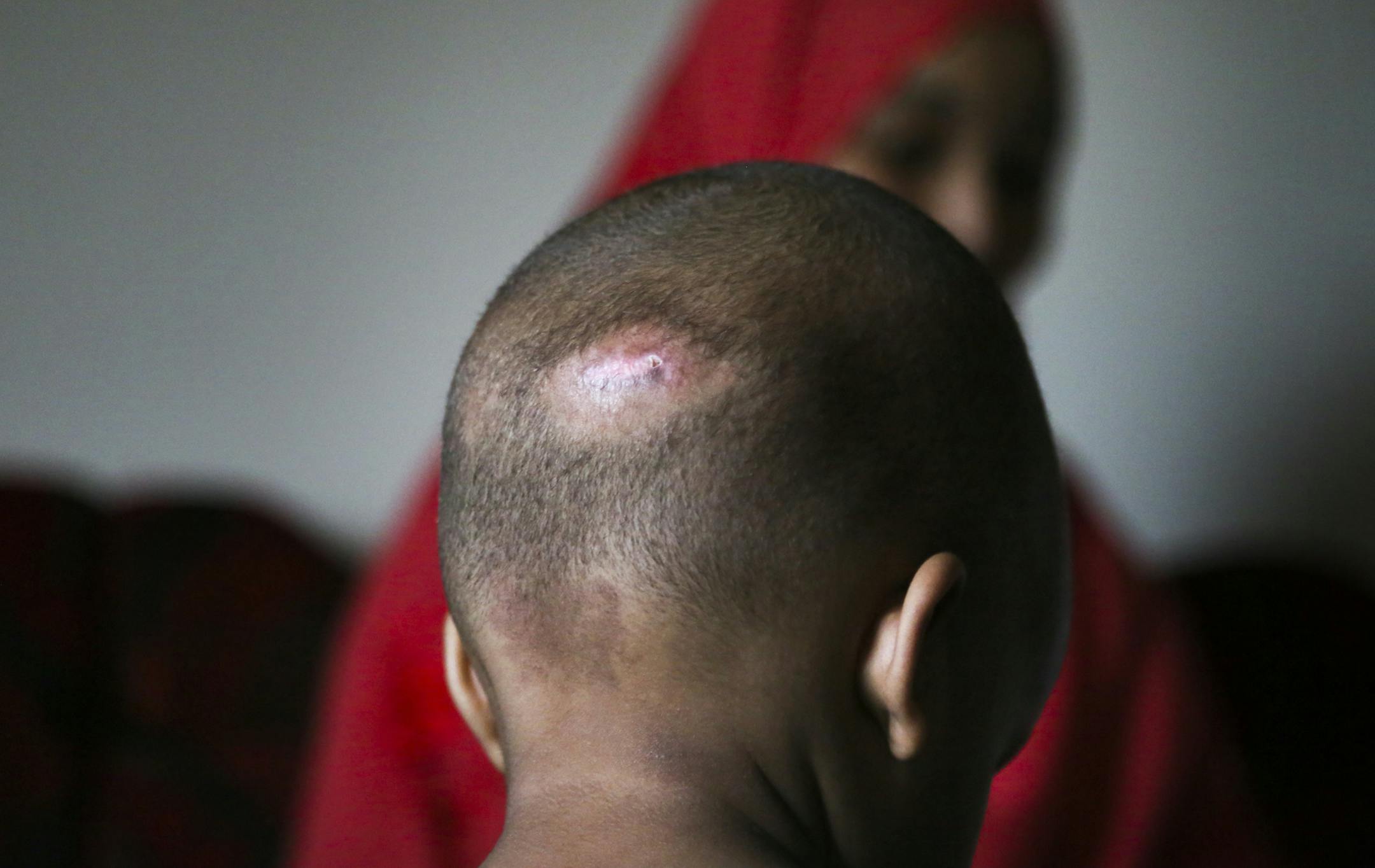 Fadumo Abudllahi talks about her son Musa, 16 months, a month after Musa fell 11 stories from the family's Cedar-Riverside apartment. One of the few visible exernal scars came from a cut and bruise on the back of Musa's head.