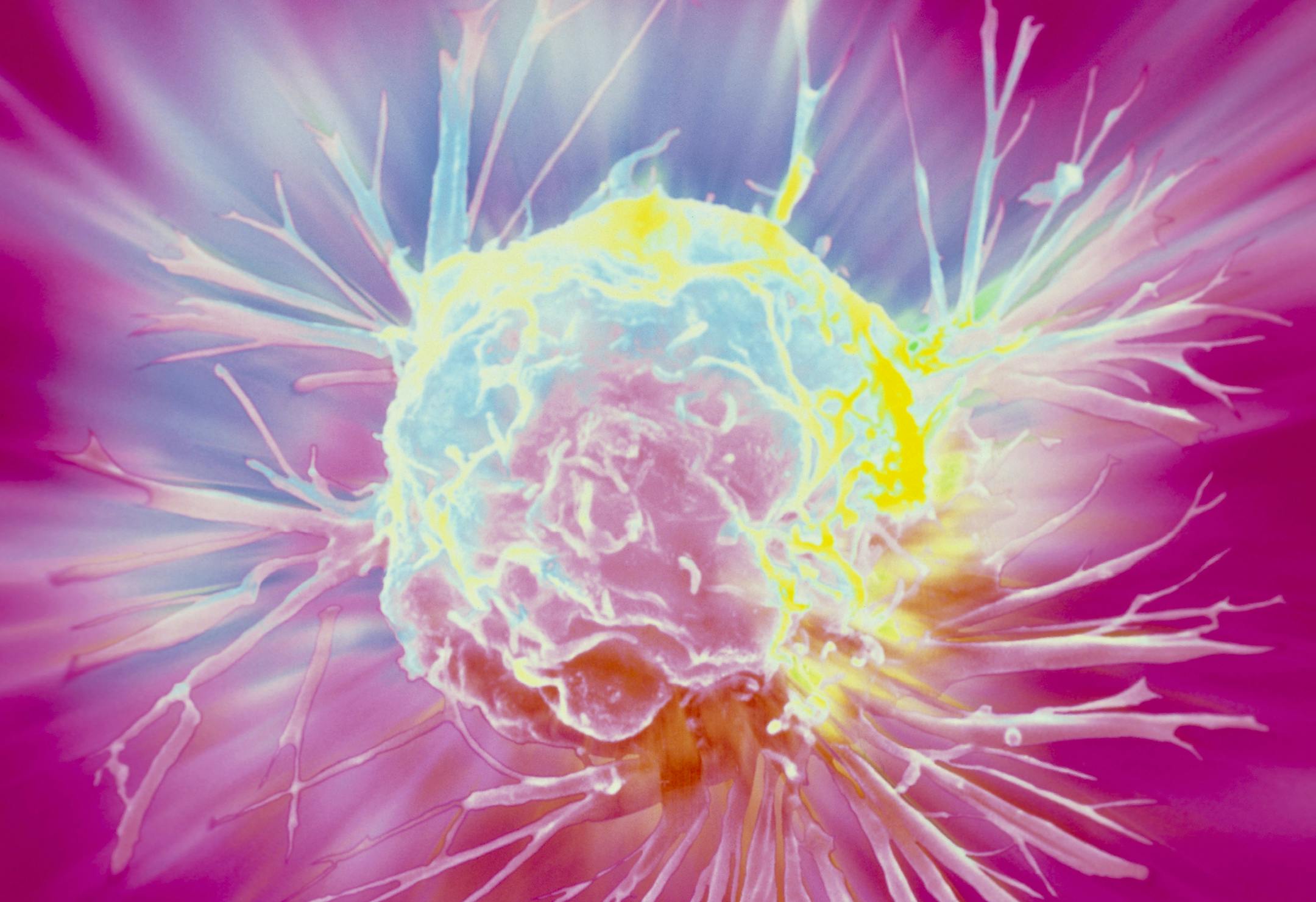 Breast cancer cell. Coloured scanning electron micrograph (SEM) of a single breast cancer cell, showing its uneven surface and cytoplasmic projections. Clumps of cancerous (malignant) cells form tumours, which possess the ability to invade and destroy surrounding tissues and travel to distant parts of the body to seed secondary tumours. Malignant cells proliferate and grow in a chaotic manner, with defective cell division retained within each new generation of cells. Variations also occur in siz