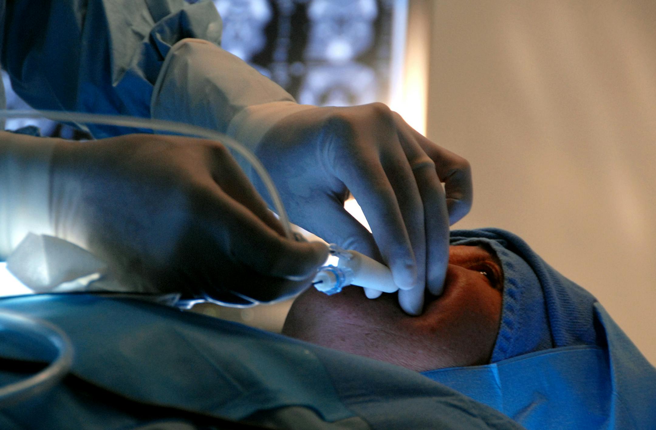 Dr. Ted Truitt performed sinus surgery in 2008 and talked to the patientduring the procedure. Entellus Medical and Truitt developed the sinus operation which involves inserting a balloon catheter into the sinus cavity through an opening above the incisors, then inflating the balloon to force open a pathway so that mucus can drain properly. The patient is under a local anesthesia.