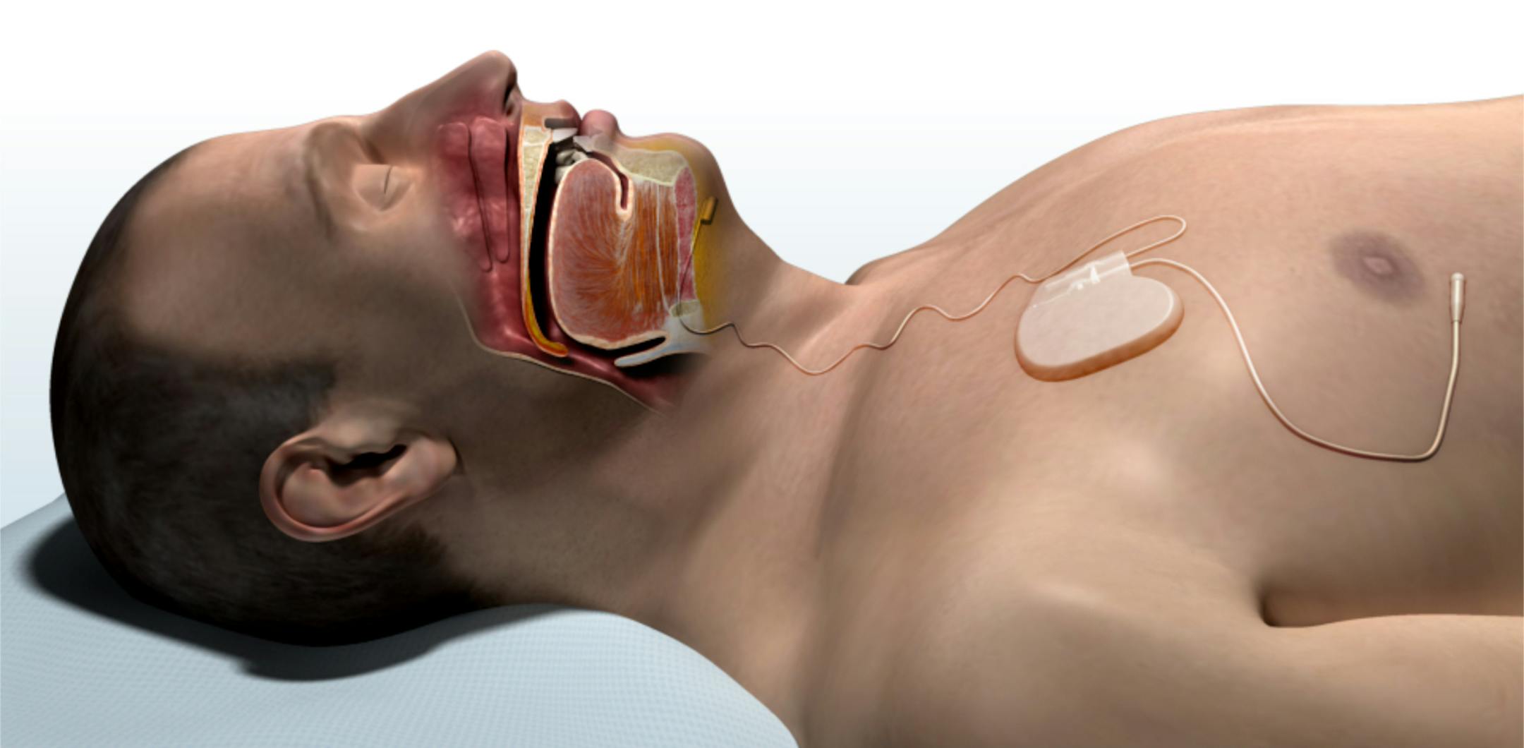 Inspire¬Æ Upper Airway Stimulation (UAS) therapy Inspire Upper Airway Stimulation (UAS) therapy offers an alternative, proven treatment option for a subset of moderate to severe Obstructive Sleep Apnea (OSA) patients who have not found relief from traditional treatment options. Inspire therapy is a fully implanted system consisting of three components: a small pulse generator, a sensing lead, and a stimulation lead. The single external component, a small handheld Inspire sleep remote,