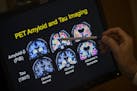 FILE - In this May 19, 2015, file photo, a doctor points to PET scan results that are part of a study on Alzheimer's disease at a hospital in Washingt