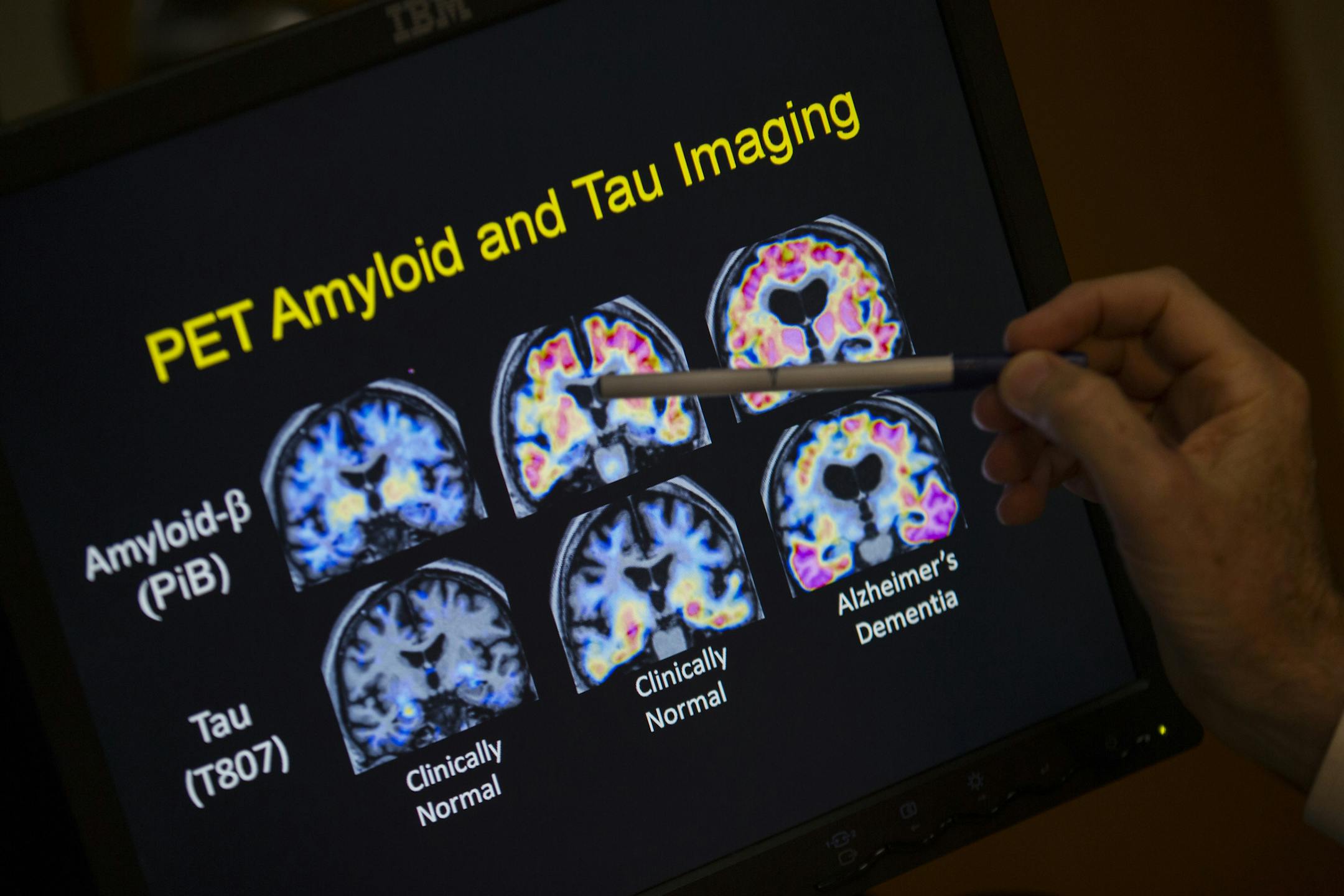 FILE - In this May 19, 2015, file photo, a doctor points to PET scan results that are part of a study on Alzheimer's disease at a hospital in Washington. Scientists know that long before the memory problems of Alzheimer's become obvious, people experience more subtle changes in their thinking and judgment. (AP Photo/Evan Vucci, File)