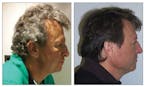 This undated combination of photos provided by the Journal of the American Medical Association in July 2017 shows a cancer patient with gray hair that