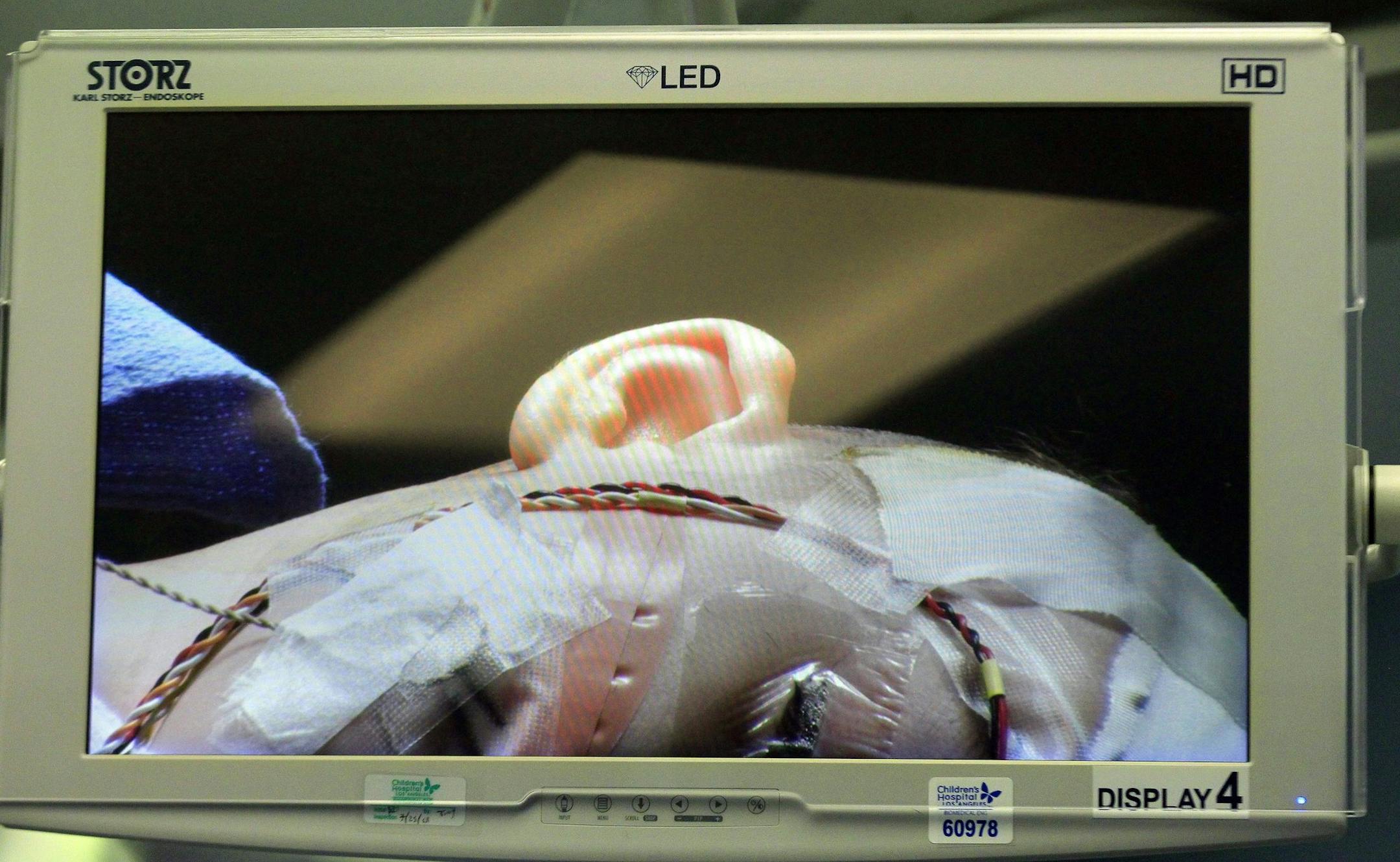 Three-year-old Auguste Majkowski's head is taped with wires and electrodes that monitor his brain and nerve functions during a surgery at Children's Hospital Los Angeles on May 6, 2014. Surgeons implanted an auditory device into Auguste's brain stem during the six-hour operation. (Brian van der Brug/Los Angeles Times/MCT)