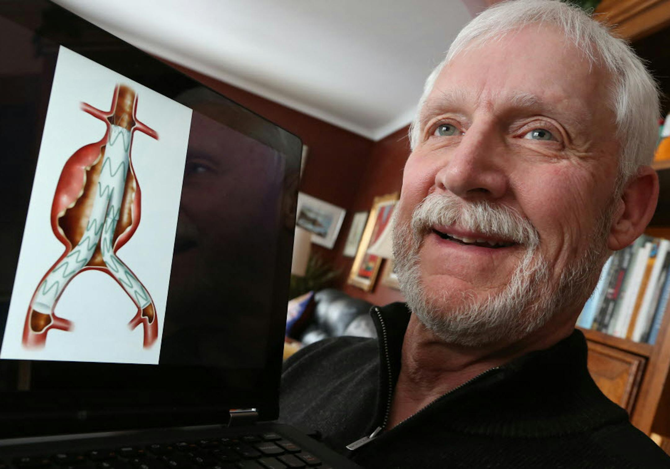 Peter Eichten had a custom-made stent graft placed in his aorta by doctors at Abbott-Northwestern Hospital after he was diagnosed with an aneurysm.