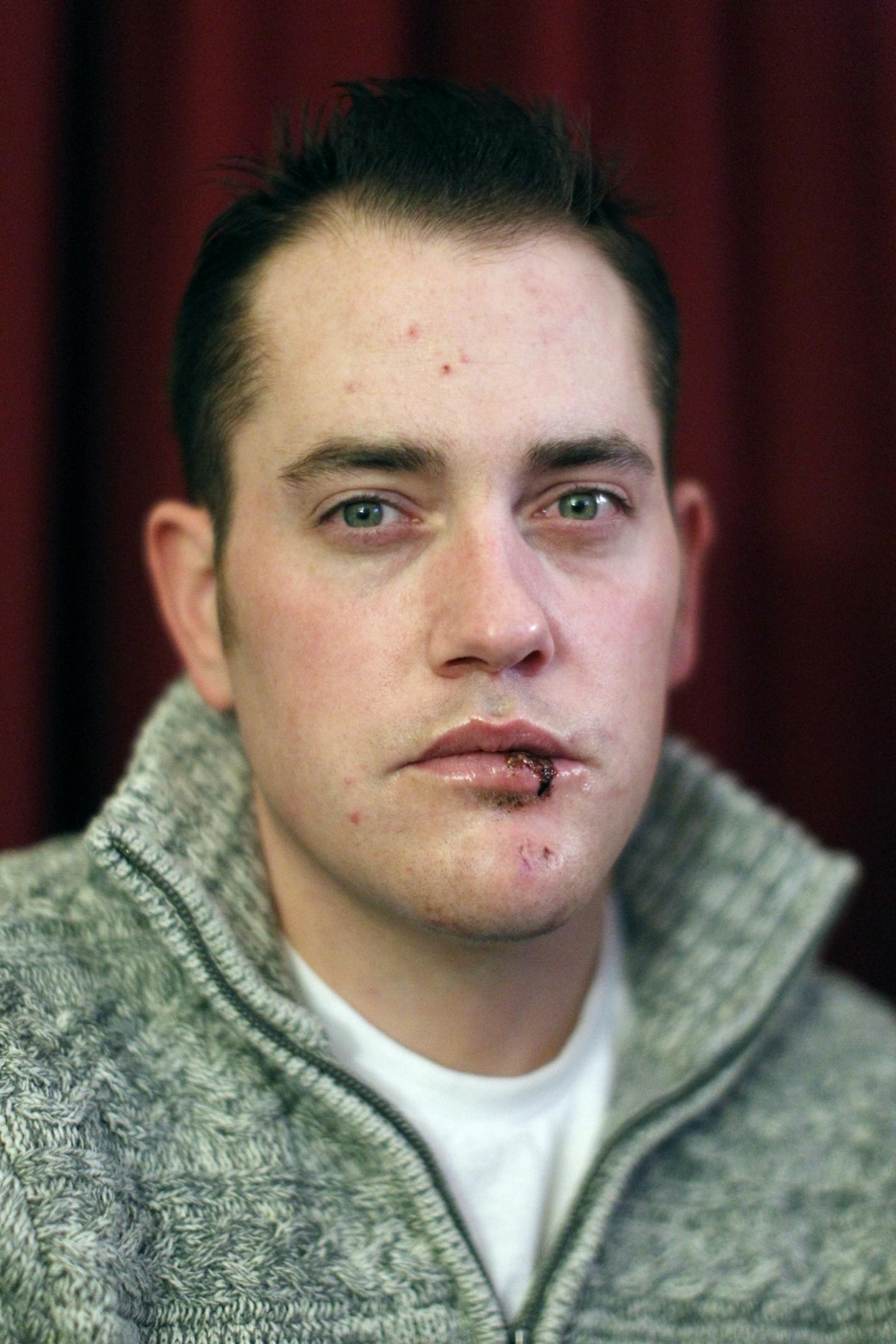 Jon Stacke was the victim of the vise throwing incident which broke his jaw and shattered his teeth.