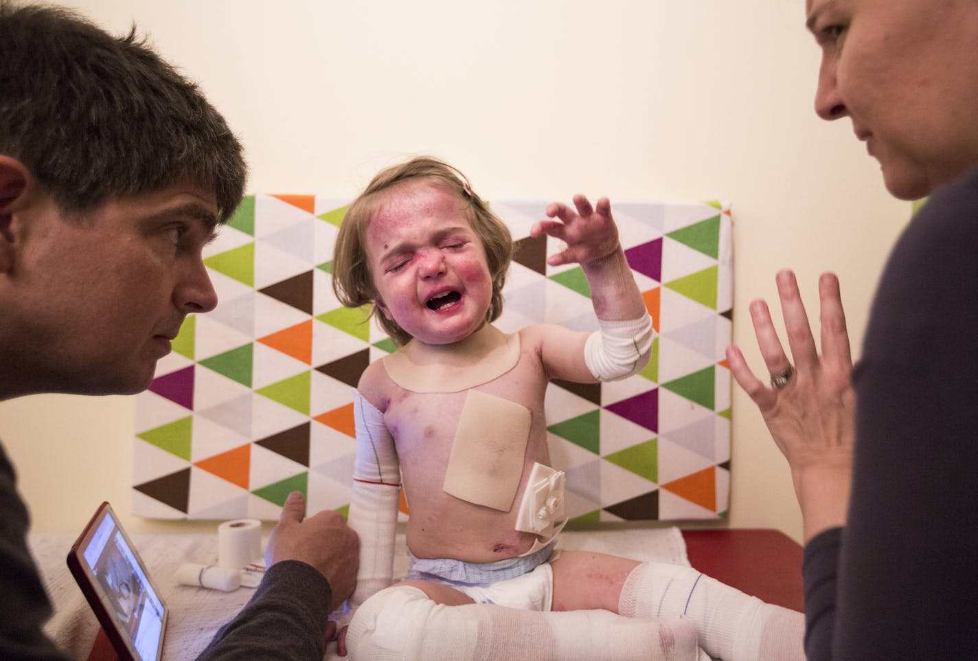 Dagan and Gabriella McCann perform a wound dressing change on their daughter Elisa McCann, 2, a painful nightly ritual before bedtime in their St. Paul home on Tuesday, October 6, 2015. ] LEILA NAVIDI leila.navidi@startribune.com / BACKGROUND INFORMATION: 2-year-old Elisa McCann was born with a genetic condition, epidermolysis bullosa, that causes her skin to blister and sluff off at the slightest contact. It's like having third-degree burns all over your body and drugs like oxycodone and morphi