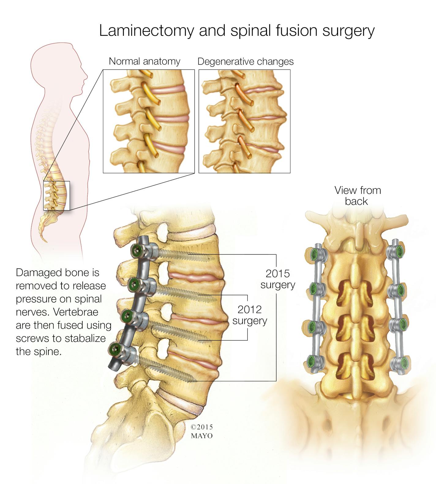 This graphic shows both the procedure Gov. Mark Dayton had in 2012 and the recent surgery.