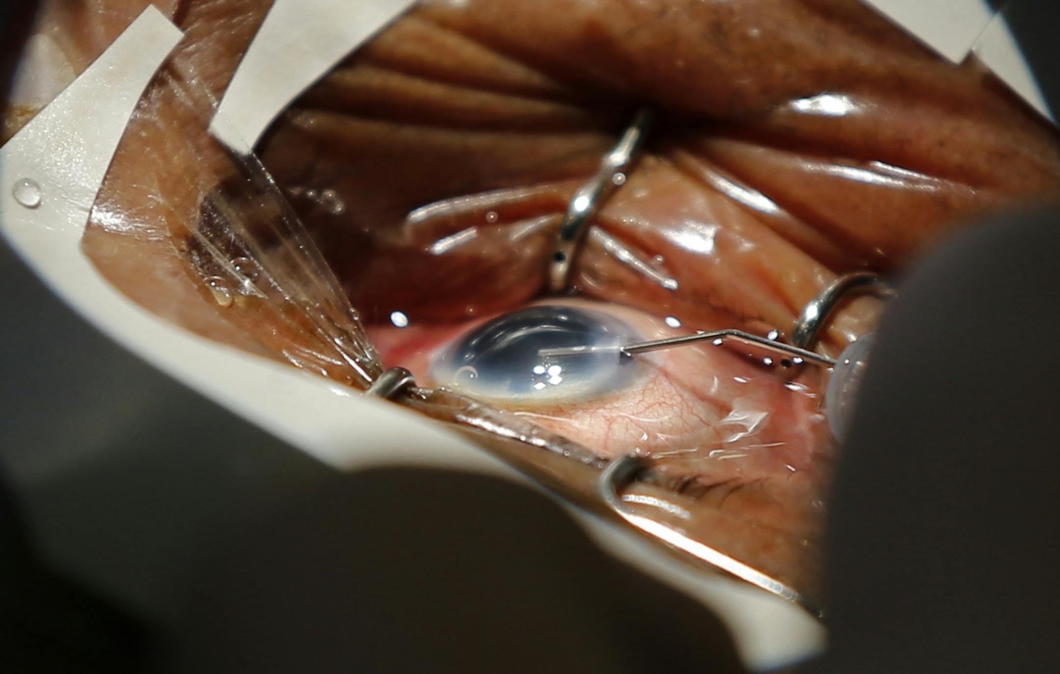 An 87-year old patient whose cataract had been bothering her for several years had it removed through the Minnesota Vision Project.
