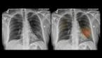 Two X-ray images show a patient's diseased lungs. Using an artificial intelligence program developed by UC San Diego Health system, the image on the r