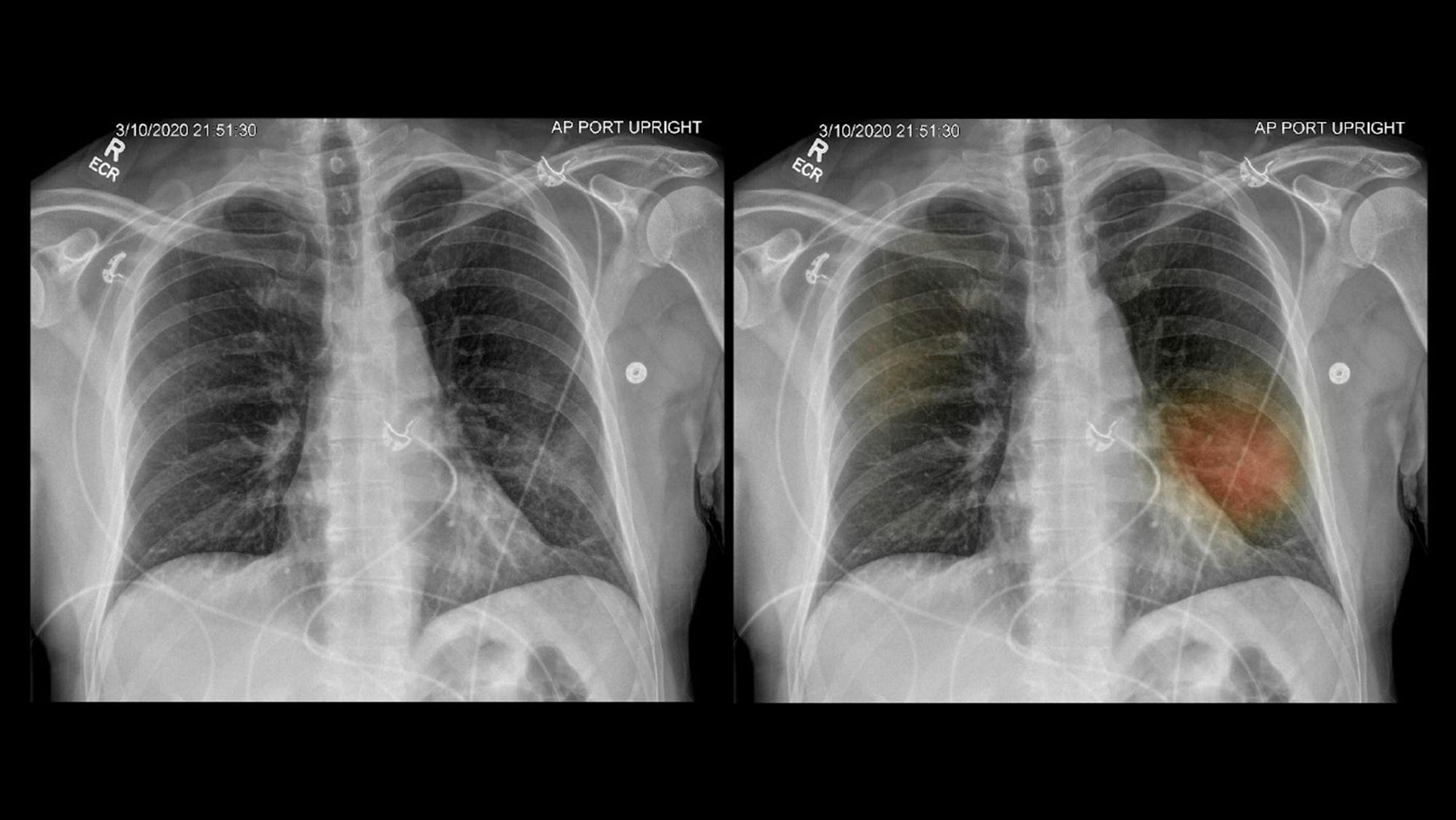 Two X-ray images show a patient's diseased lungs. Using an artificial intelligence program developed by UC San Diego Health system, the image on the right has been dotted with spots of color indicating where there may be lung damage or other signs of pneumonia. (Courtesy of Dr. Albert Hsiao/KHN/TNS)