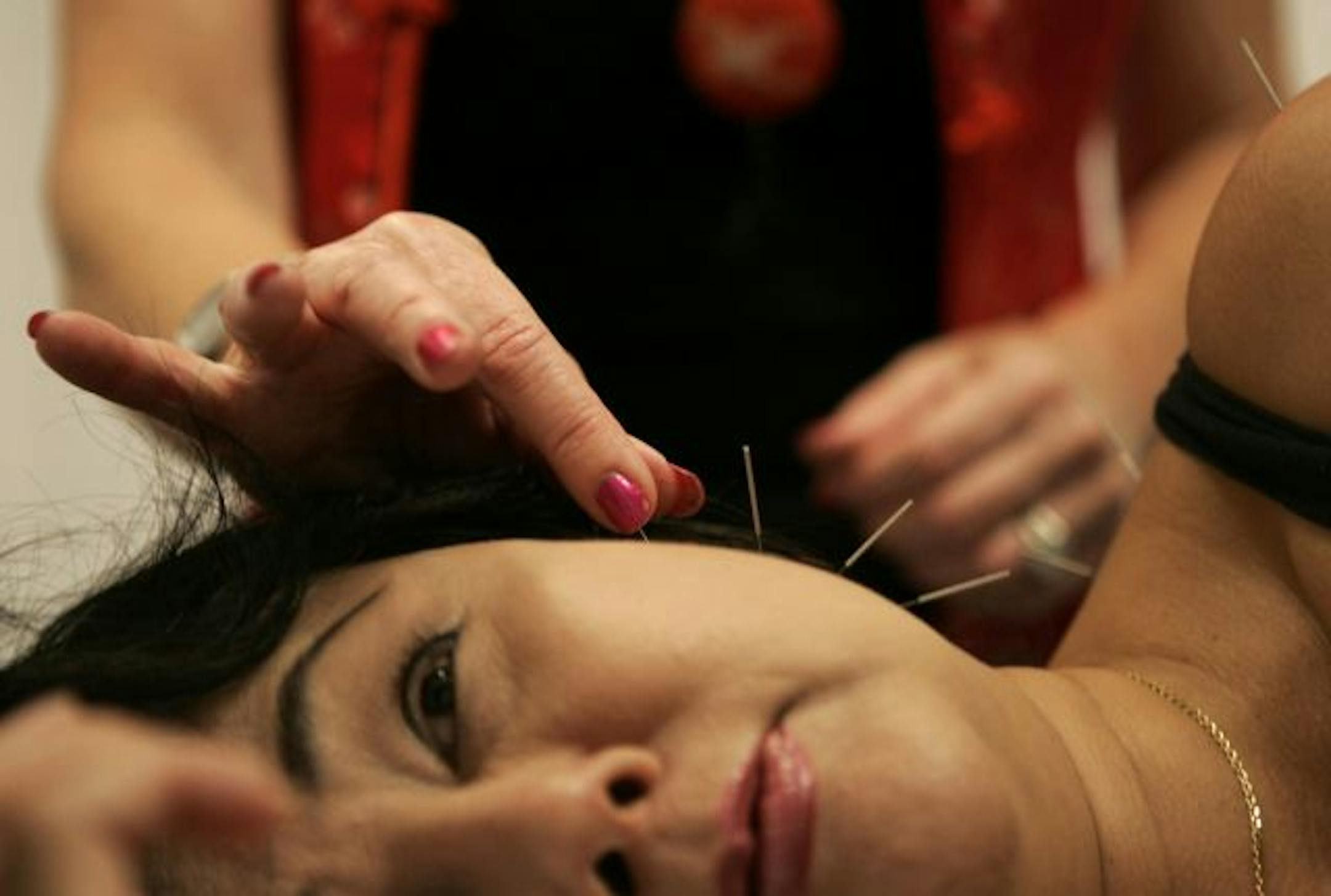 Acupuncturist Robin Hays uses needles in the ear of Lehang Bynum to treat her shoulder pain in her office in Milpitas, California.