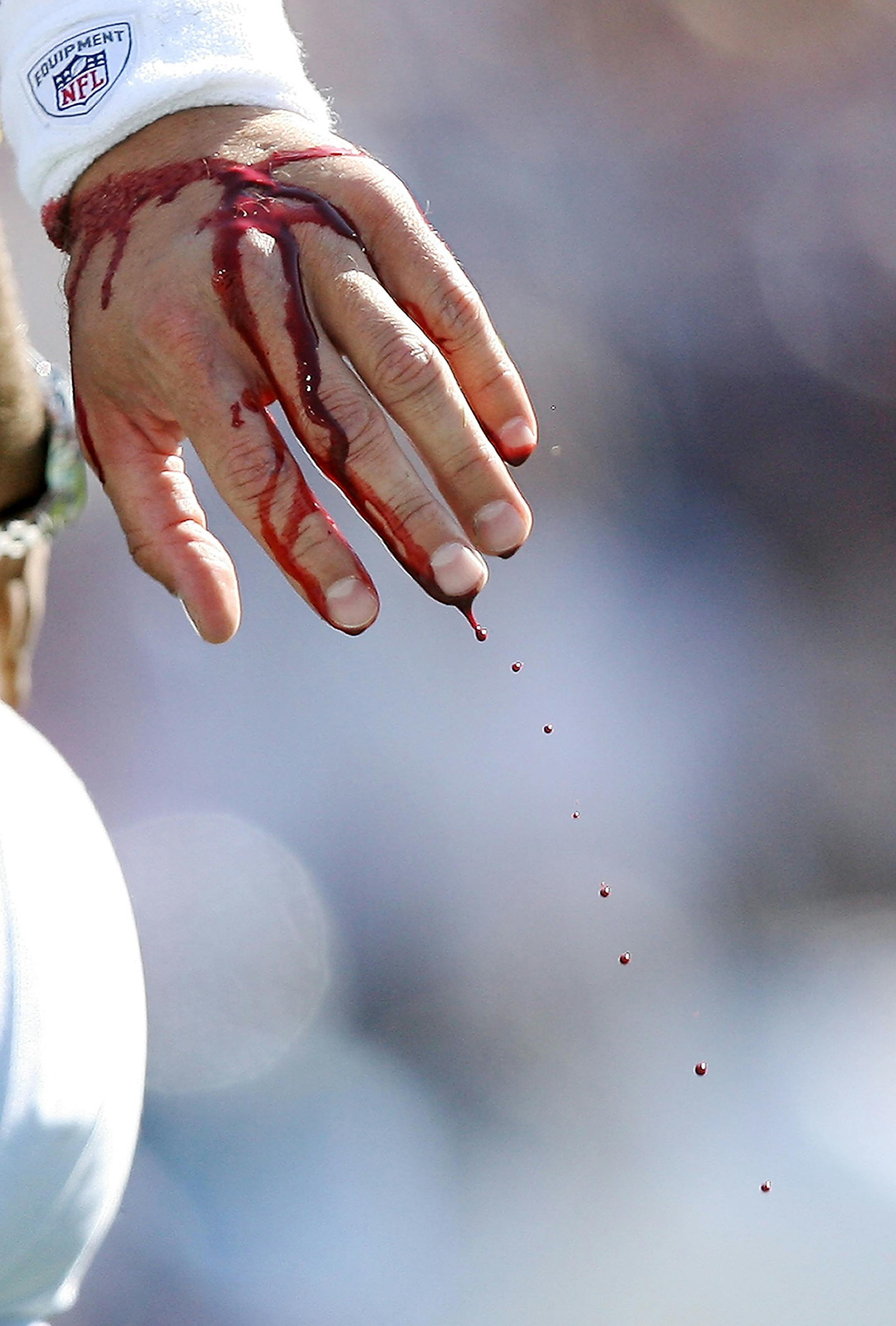 NASHVILLE, TN - SEPTEMBER 28: Quarterback Gus Frerotte #12 of the Minnesota Vikings holds his bleeding hand out as he is knocked out of the game after an interception late in the game against the Tennessee Titans at LP Field on September 28, 2008 in Nashville, Tennessee. The Titans defeated the Vikings 30-17.