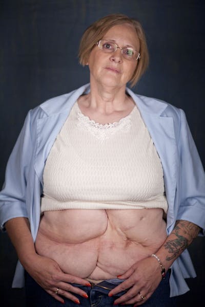 Terri Little, in a portrait at her home in Sheldon, ND Wednesday evening, January 18, 2011. Dr. James Wasemiller performed gastric bypass surgery on h