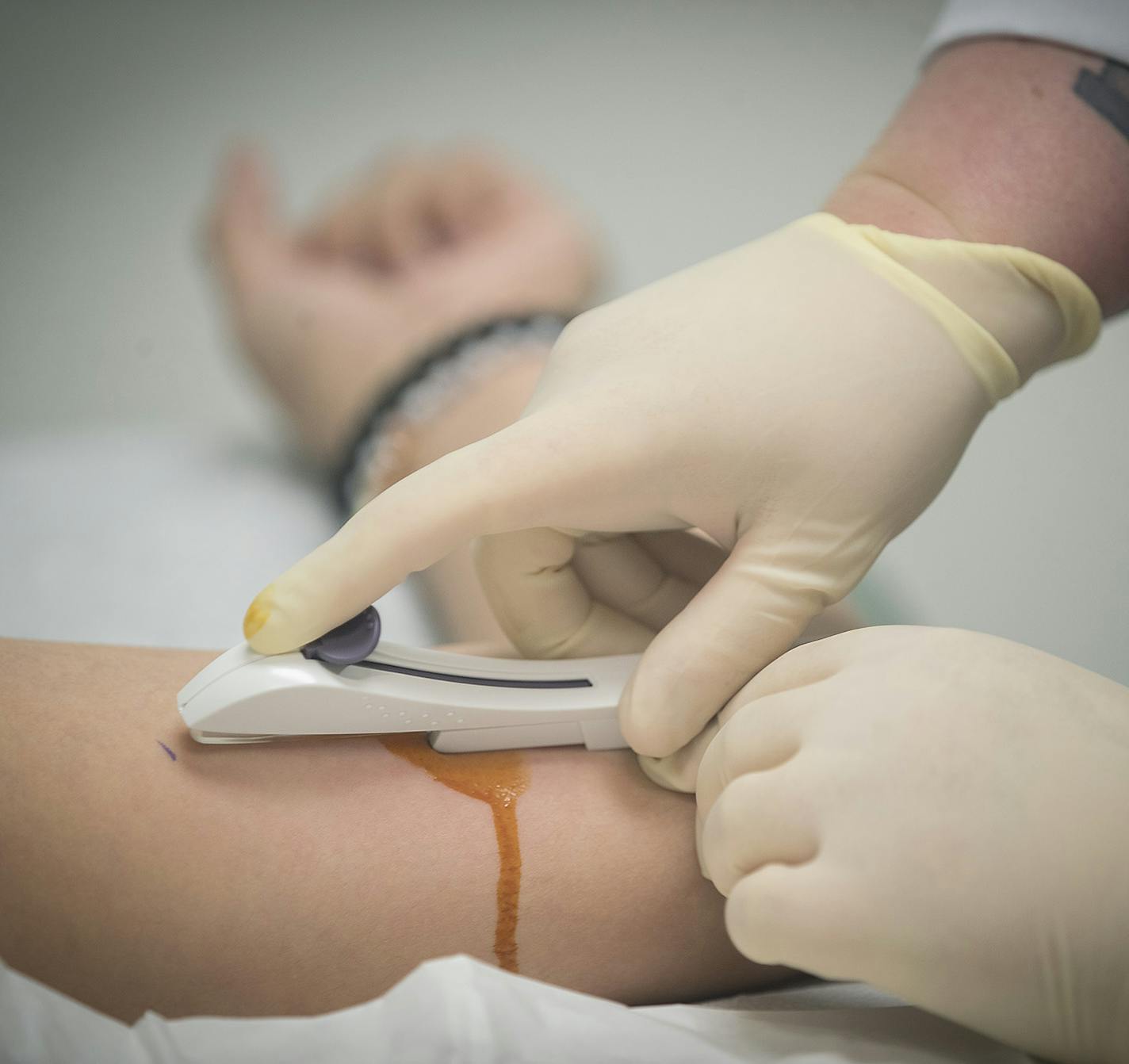 Nurse Practitioner Jessica Zaldivar injected a Nexplanon birth control implant into patient Andrea Castillo, 22, at a Planned Parenthood facility, Thursday, May 4, 2017 in Minneapolis, MN. ] ELIZABETH FLORES &#x2022; liz.flores@startribune.com