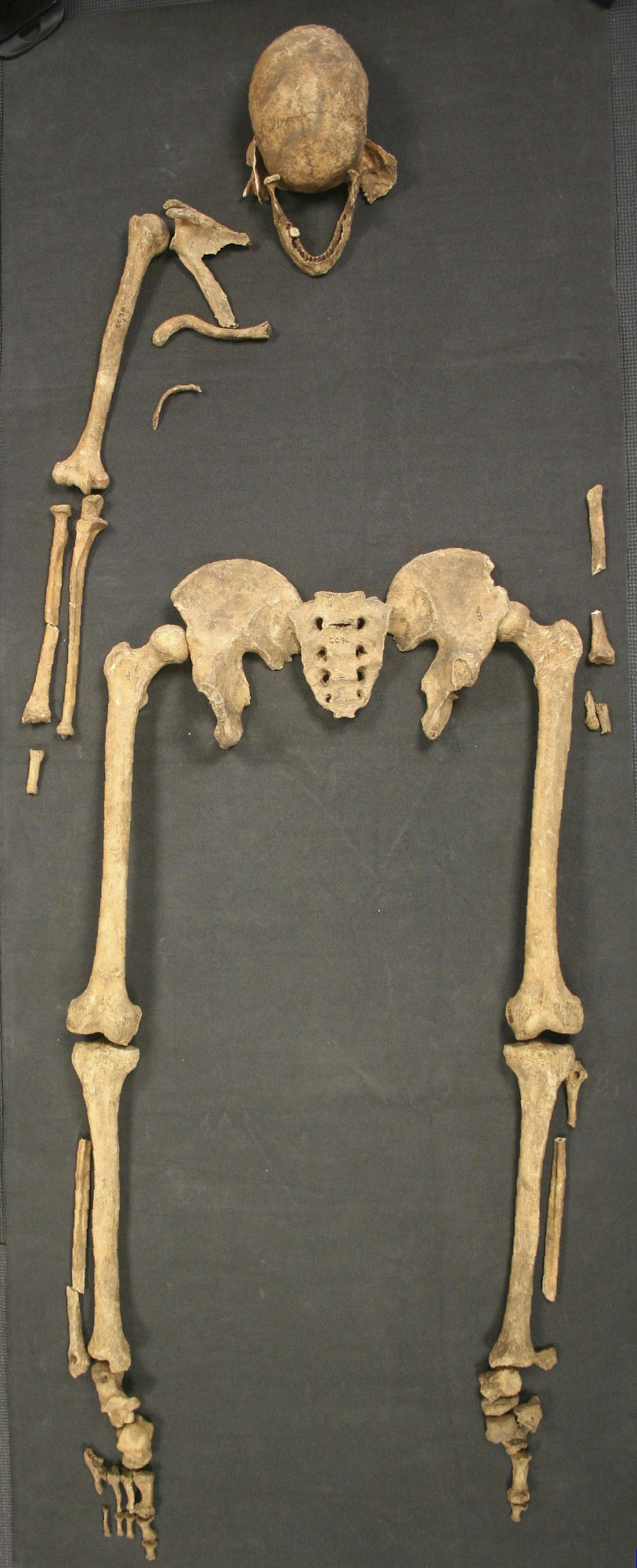 In an undated handout photo, an ancient skeleton shows leprosy may have spread to Britain from Scandinavia. DNA and isotope analyses confirm the leprosy diagnosis and suggest that the man was originally from southern Scandinavia, possibly the region that is now Denmark. The strain of leprosy he carries dates to the fifth or sixth century A.D. (University of Southampton via The New York Times) -- NO SALES; FOR EDITORIAL USE ONLY WITH STORY SLUGGED SCI WATCH BY SINDYA N. BHANOO. ALL OTHER USE PROH