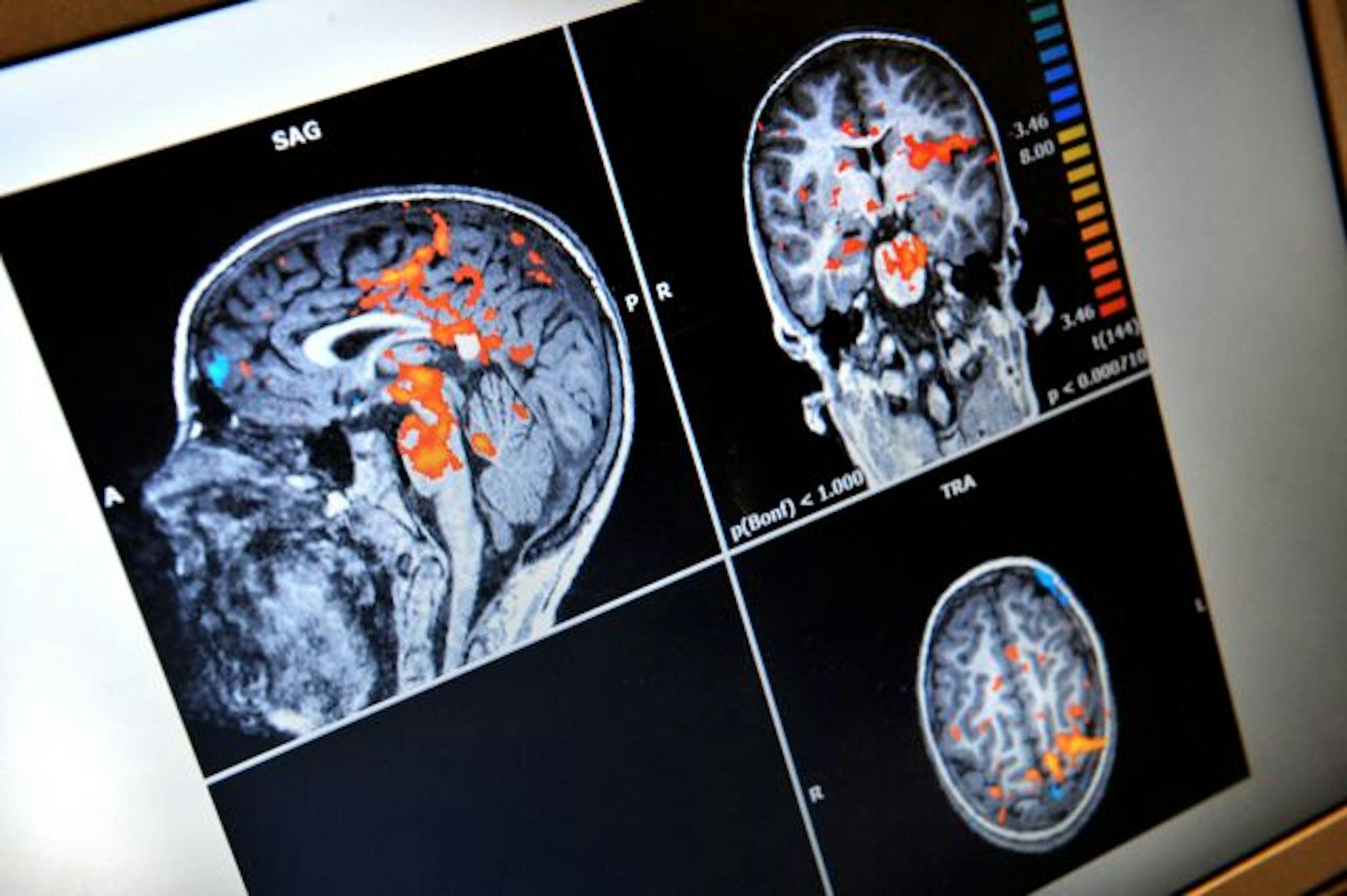 Bernadette Gillick and researcher James Carey are running an NIH funded study to see if brain stimulation can help paralyzed children. This photo shows brain activity in a test subject