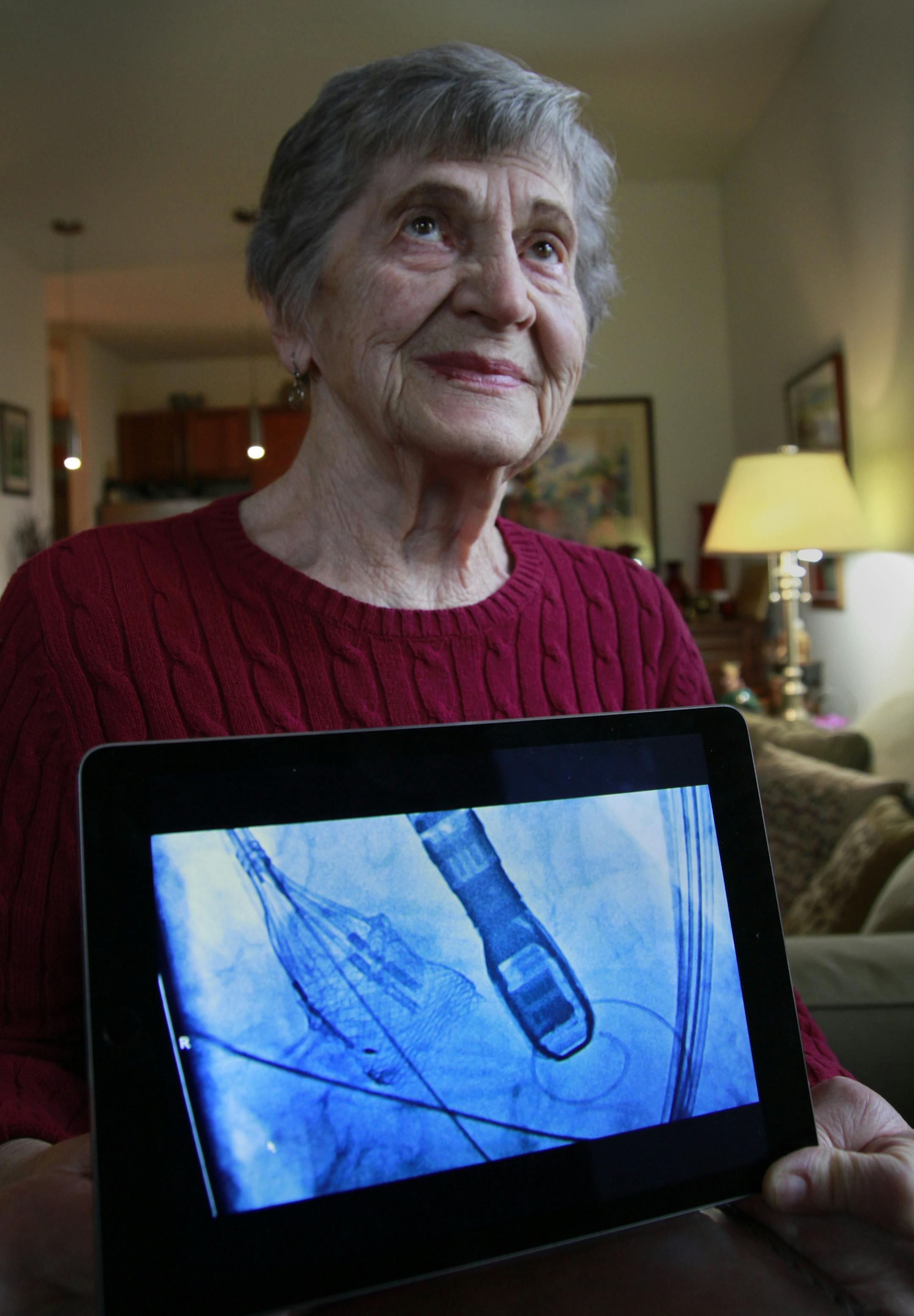 Anna Schu, displays an image on an iPad that was made while she was undergoing a procedure to implant an artificial aortic valve in here heart. ] Tom Sweeney, March 12, 2015, Minneapolis, MN.