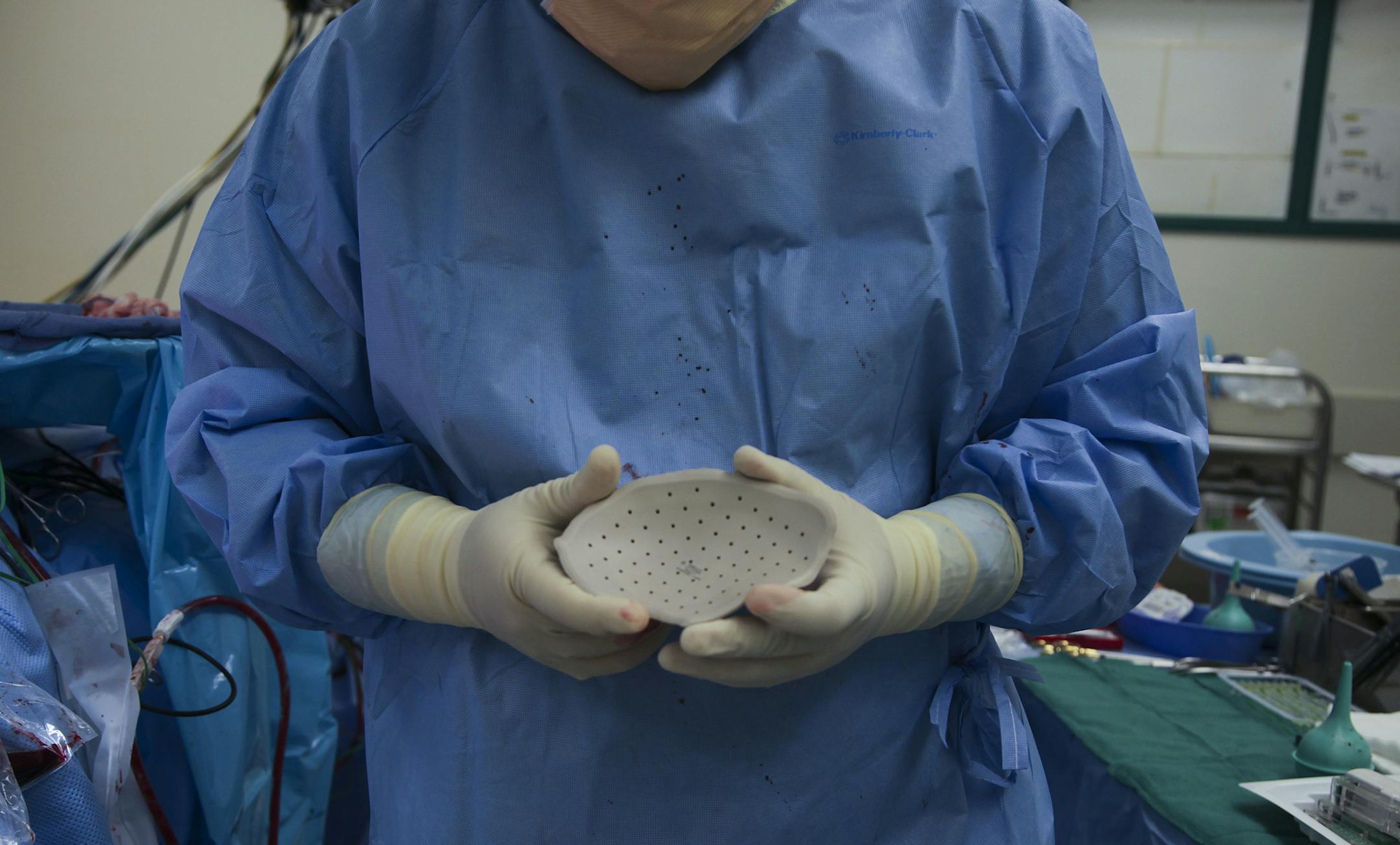 Dr. Geoffrey Manley of San Francisco General Hospital holds a cranial prosthesis to be fitted in a patient who suffered traumatic brain injury after falling from a window, in San Francisco, April 11, 2013. Partial skull removal, used to relieve life-threatening pressure in the brain after a traumatic injury or severe stroke, raises questions about quantity versus quality of life. (Jim Wilson/The New York Times)