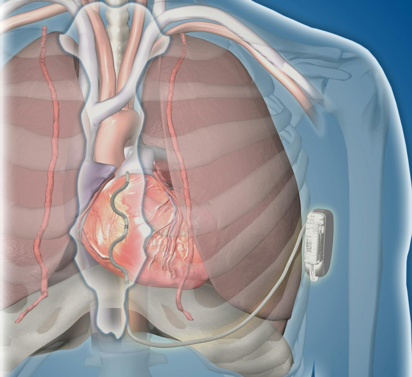 Medtronic's EV ICD system delivesr high-voltage shocks to restart the heart or re-establish normal rhythm without needing wires that physically touch the heart or blood vessels.