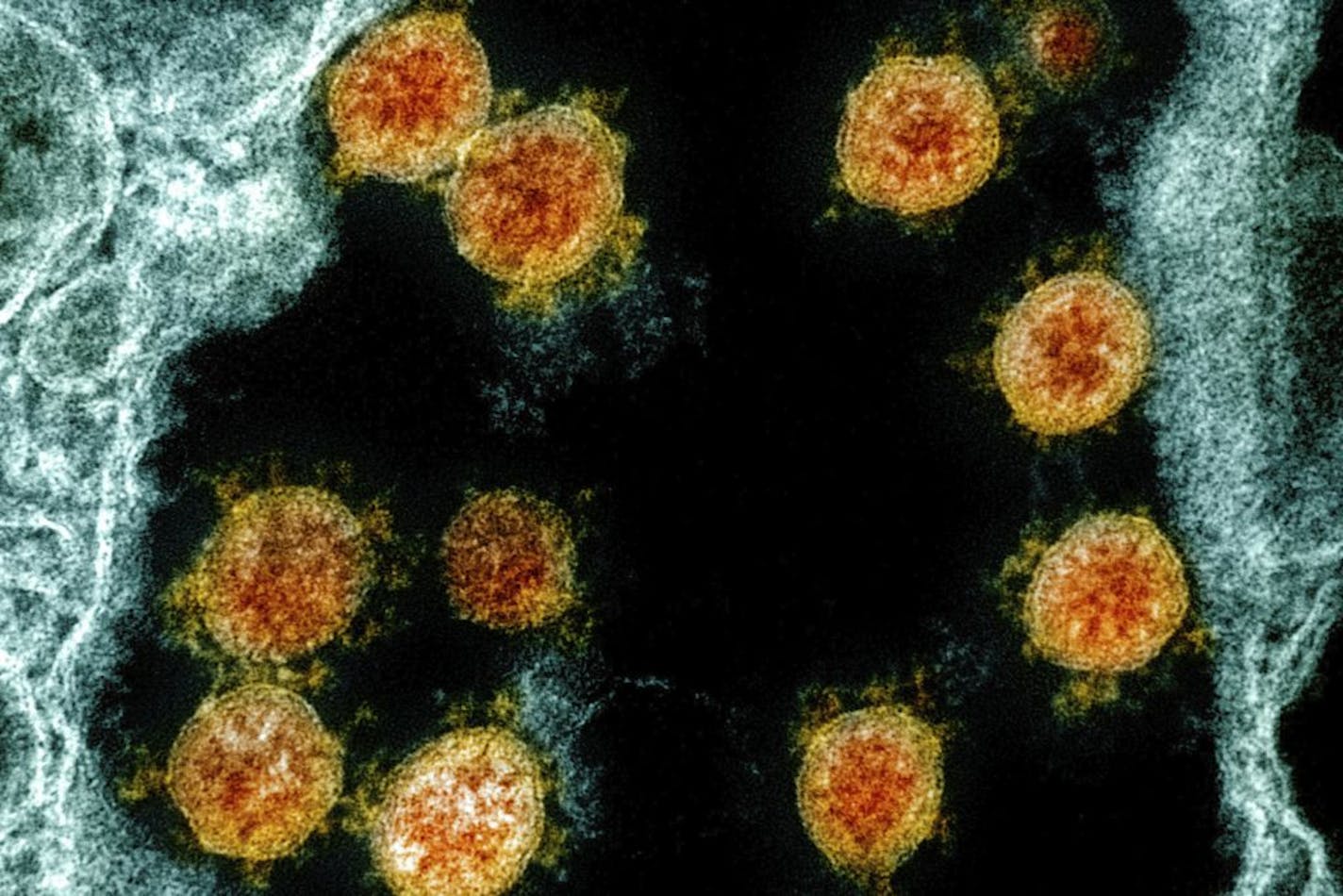 This electron microscope image made available and color-enhanced by the National Institute of Allergy and Infectious Diseases Integrated Research Facility in Fort Detrick, Md., shows Novel Coronavirus SARS-CoV-2 virus particles, orange, isolated from a patient. University of Hong Kong scientists claim to have the first evidence of someone being reinfected with the virus that causes COVID-19. They said Monday, Aug. 24, 2020 that genetic tests show a 33-year-old man returning to Hong Kong from a t