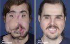 These photos provided by NYU Langone Health, show patient Cameron Underwood, left, on March 15, 2017, and right, on Oct. 17, 2018, following his face 