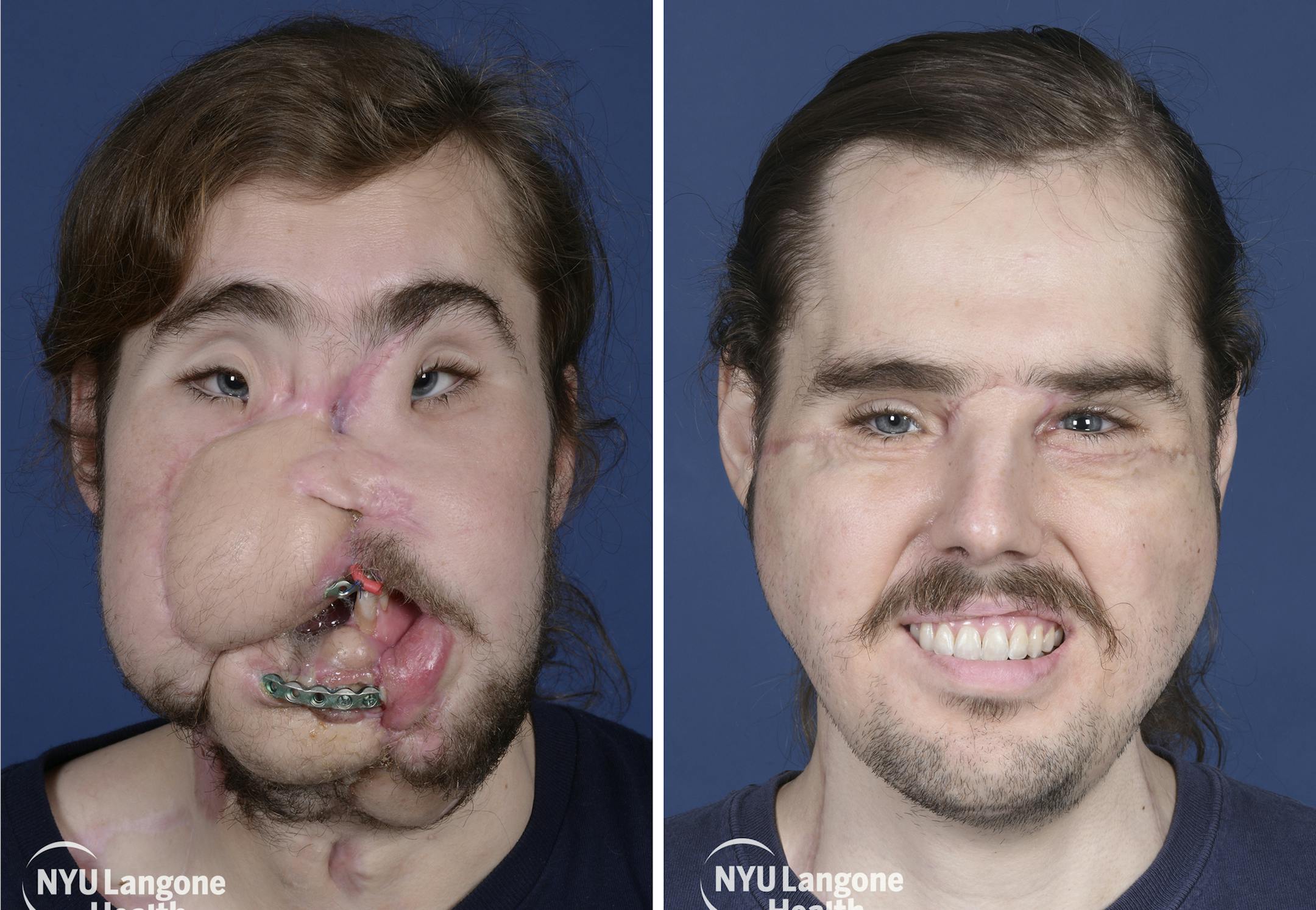 These photos provided by NYU Langone Health, show patient Cameron Underwood, left, on March 15, 2017, and right, on Oct. 17, 2018, following his face transplant. The northern California man whose suicide attempt left his face horribly disfigured had successful facial transplant surgery in early 2018. (Mary Spano/NYU Langone Health via AP)