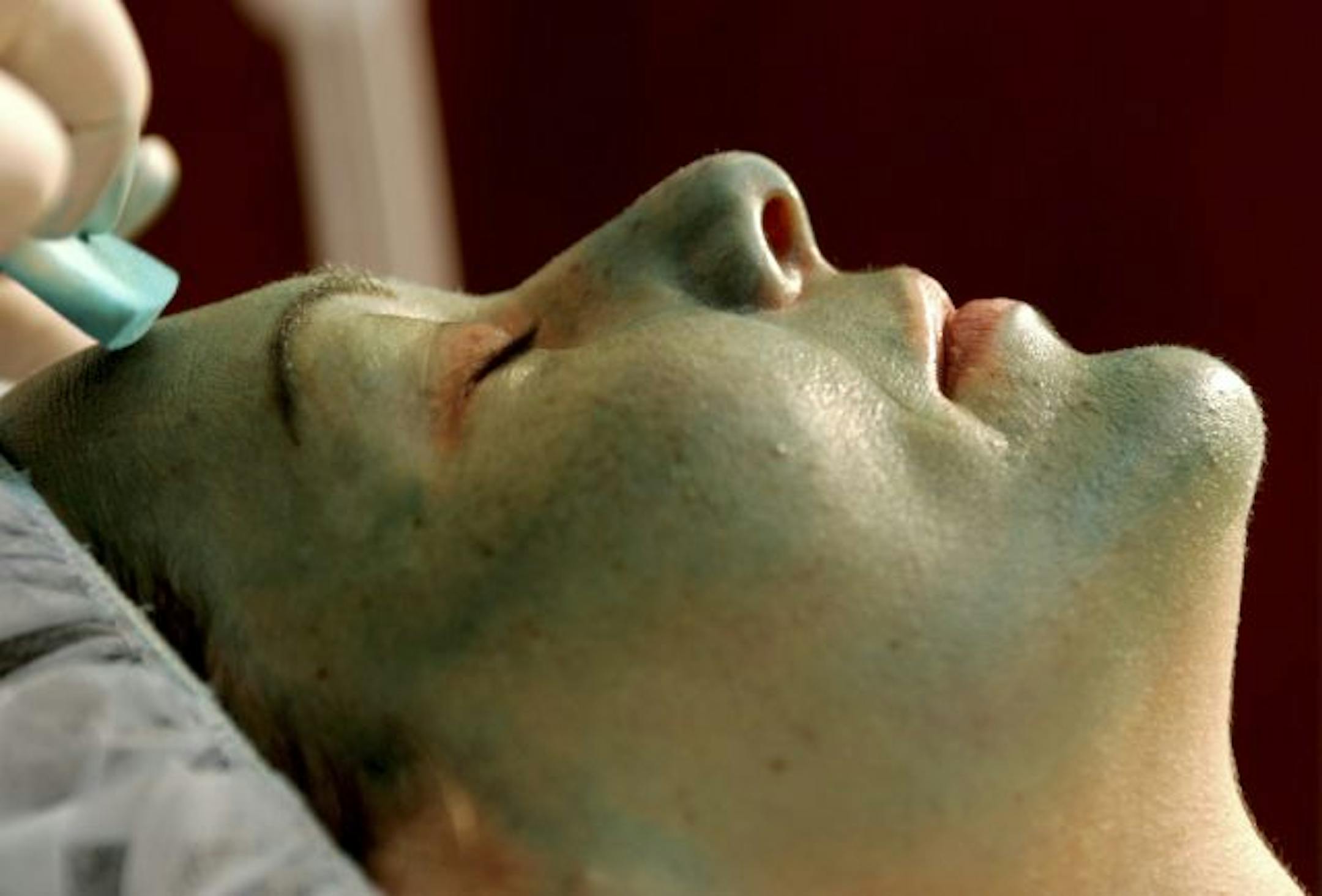 With a chemical peel, an acid solution is applied to the skin to dissolve damaged and pigmented spots.