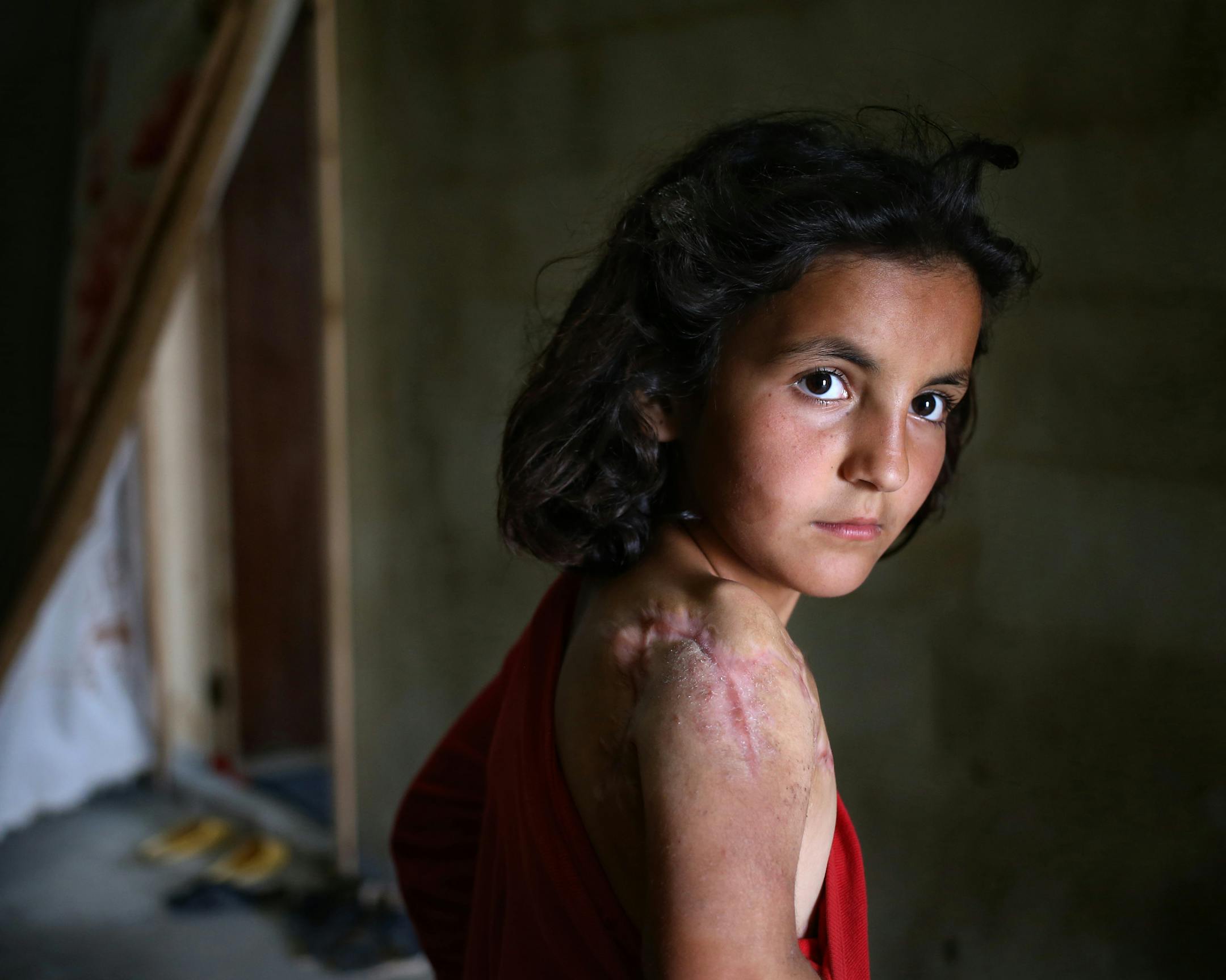 In this picture taken on Thursday, May 29, 2014, Lujain Hourani, 11, a Syrian refugee girl who lost part of her shoulder in a government forces airstrike in the Syrian village of Zara, near Homs, stands outside her family room, at a collective center where many Syrian refugees live, in Kirbet Daoud village in Akkar north Lebanon. More than 1.1 million Syrian refugees are now living in Lebanon. Most of them are either excluded or will abstain from the June 3 presidential elections in Syria. Syria