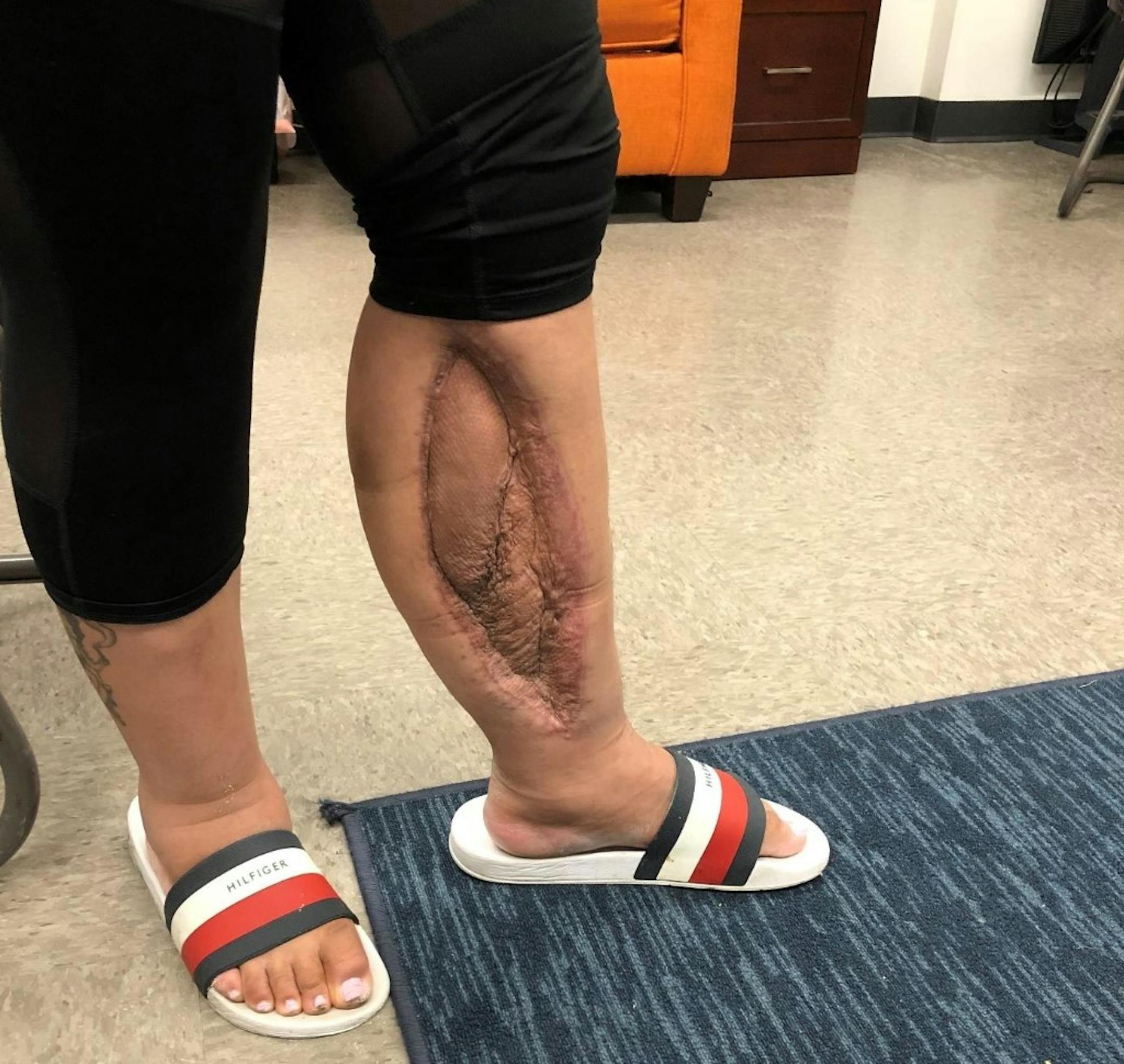 Miri Monique Mozuch-Stafford's left leg, which, according to her lawsuit against Ramsey County, was broken during an "unreasonable takedown maneuver" by jail staff in February 2021.