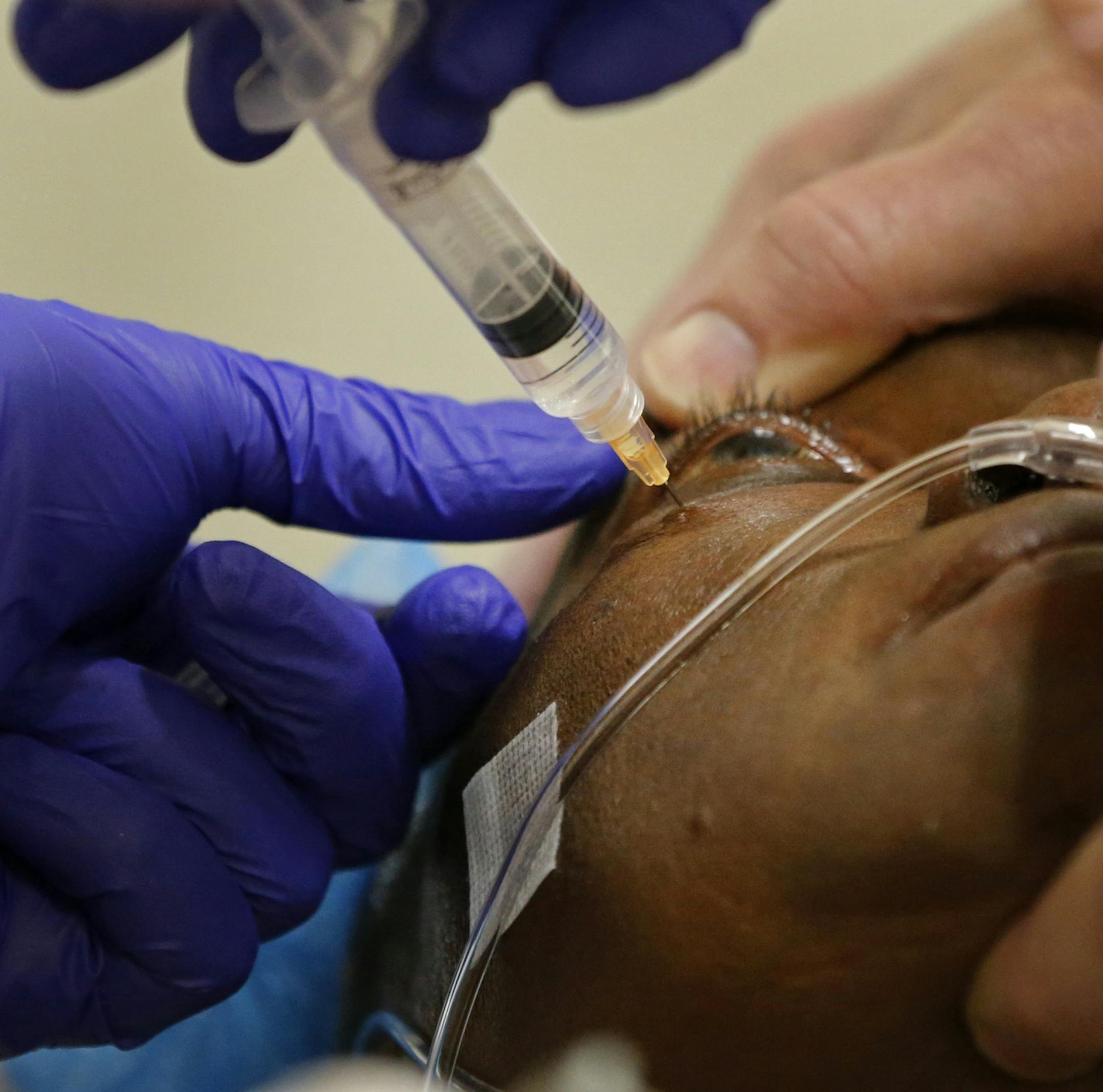 Philomena Faji was injected with a retrobulbar block before cataract removal surgery. The injection is a local anesthetic nerve block frequently used in cataract and other intraocular surgeries.
