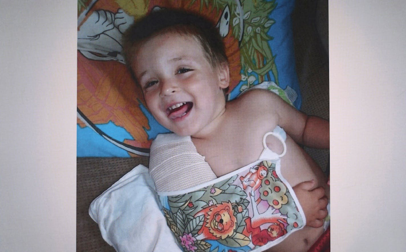 Public outrage over the abuse of 4-year-old Eric Dean, photographed here with a broken arm, triggered far-reaching reforms to Minnesota's child protection system.