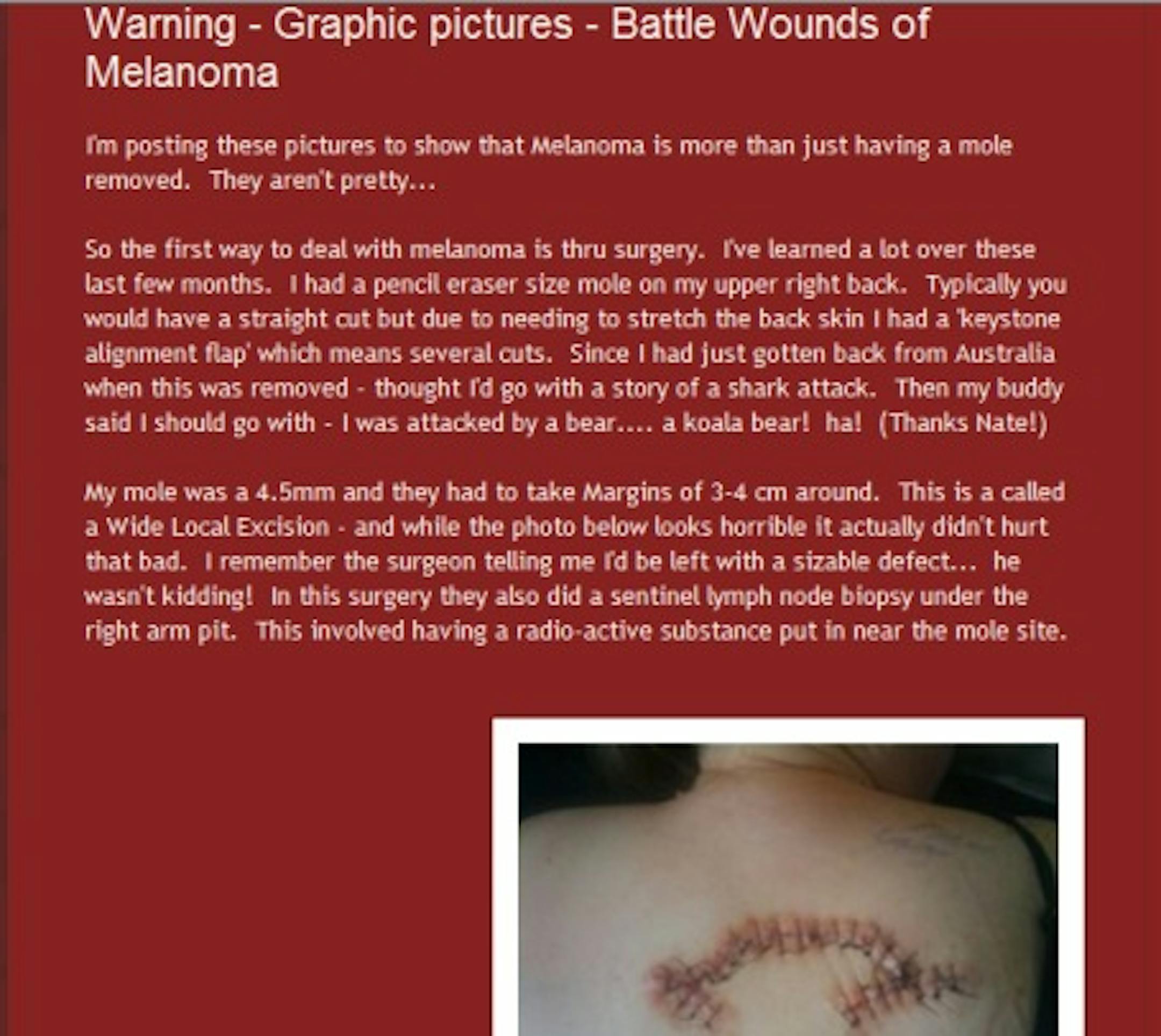 Erin Youngerberg's personal blog - Melanoma in the City