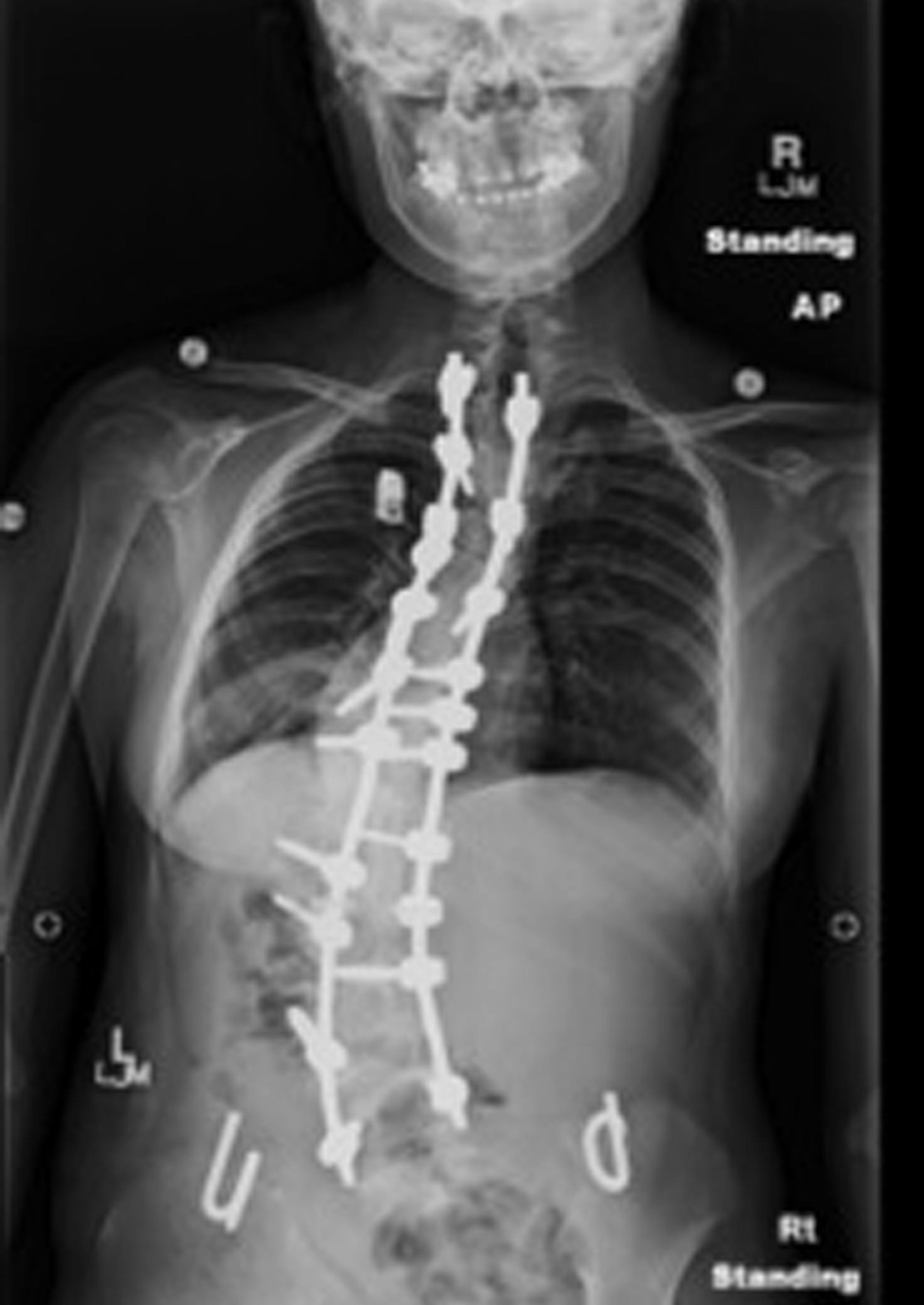 This &#xa7;X-ray of JunFen&#xed;s spine shows the shortened orthopedic screws and bracing that gradually straightened her spine. &#xa7;After 12 operations the bend in her spine has been reduced from 108 degree to 30 degrees. --- JunFen Freihammer spent 44 days at the Mayo Clinic this summer having rods put in her back to straighten out the curvature from her scoliosis birth defect. ]richard tsong-taatarii/rtsong-taataarii@startribune.com