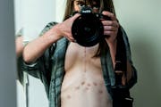 Photographer Kathleen Sheffer takes a photo of herself in a mirror with her shirt unbuttoned, showing a line of scars from a heart and lung transplant