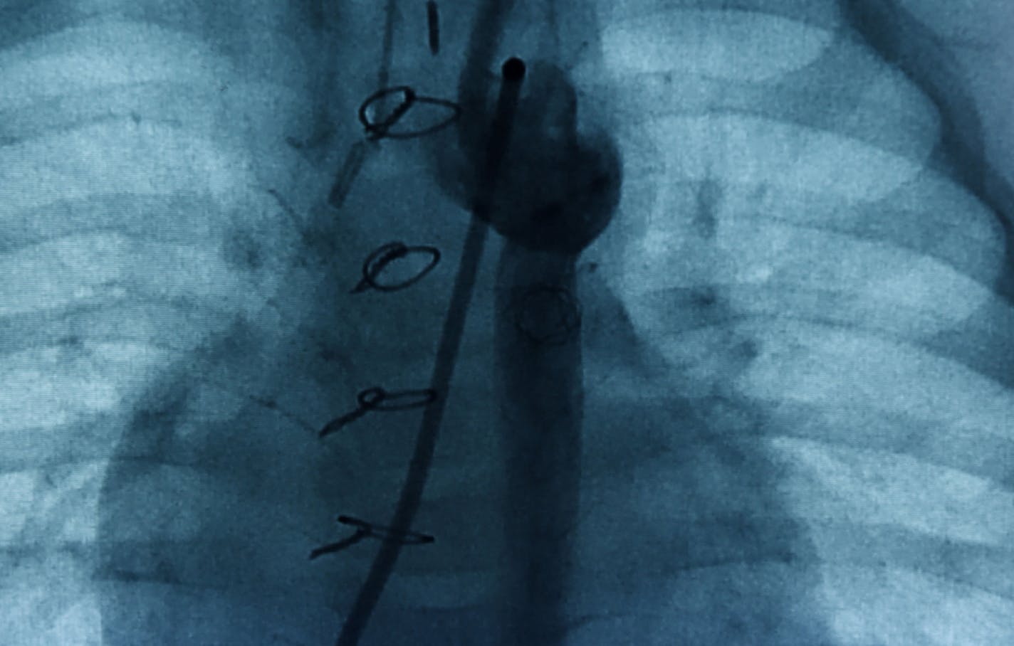 An image of Autumn Brown's heart taken before her second surgery is displayed as the 4-month-old takes part in a clinical trial. Dr. Sunjay Kaushal performs open heart surgery on Brown in a pediatric cardiology operating room at the University of Maryland Children's Hospital. She was born with hypoplastic left heart syndrome (HLHS), a condition where the left side of the heart is underdeveloped.